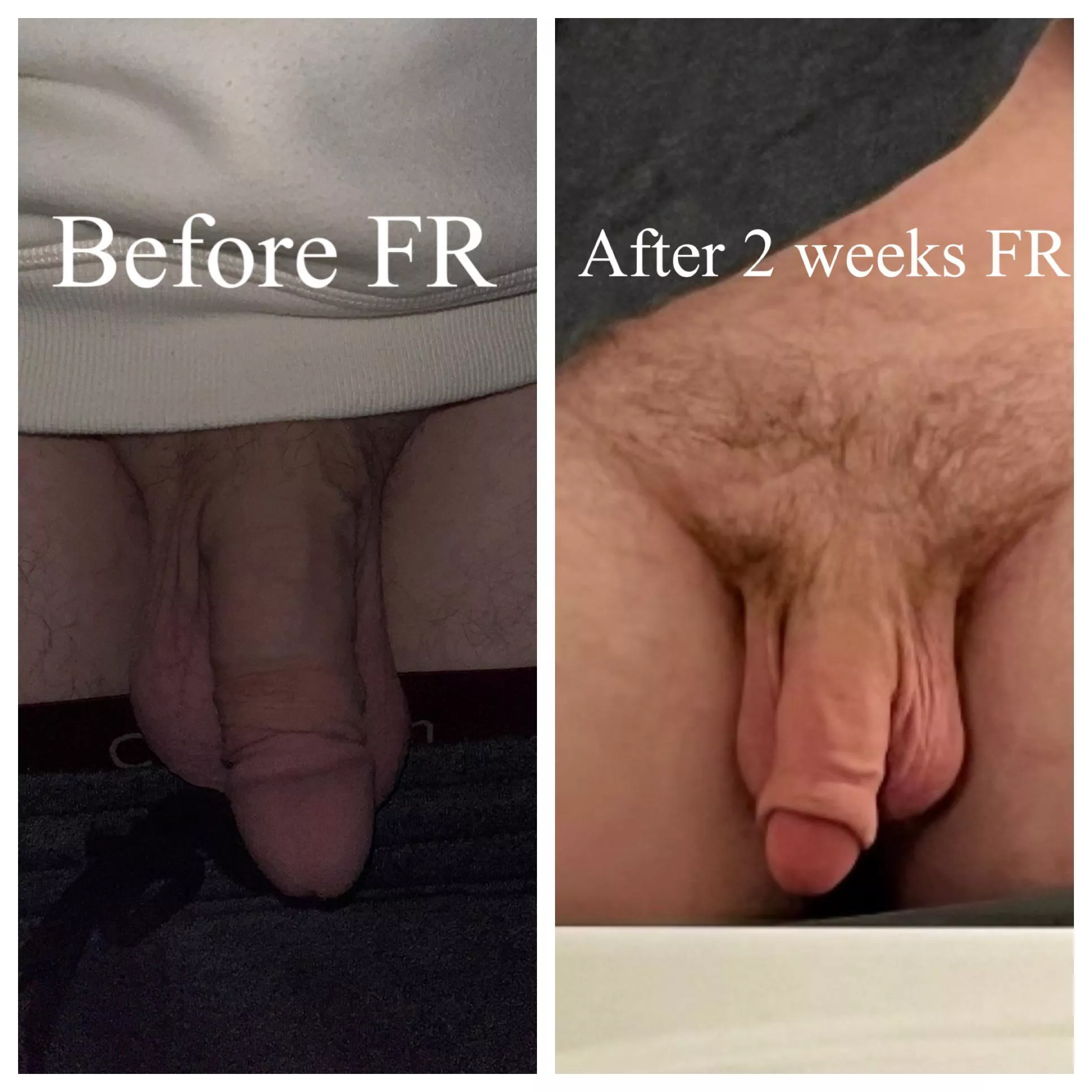 Comparing myself a few weeks after foreskin restoration! What do you think? posted by SirAnonymous32