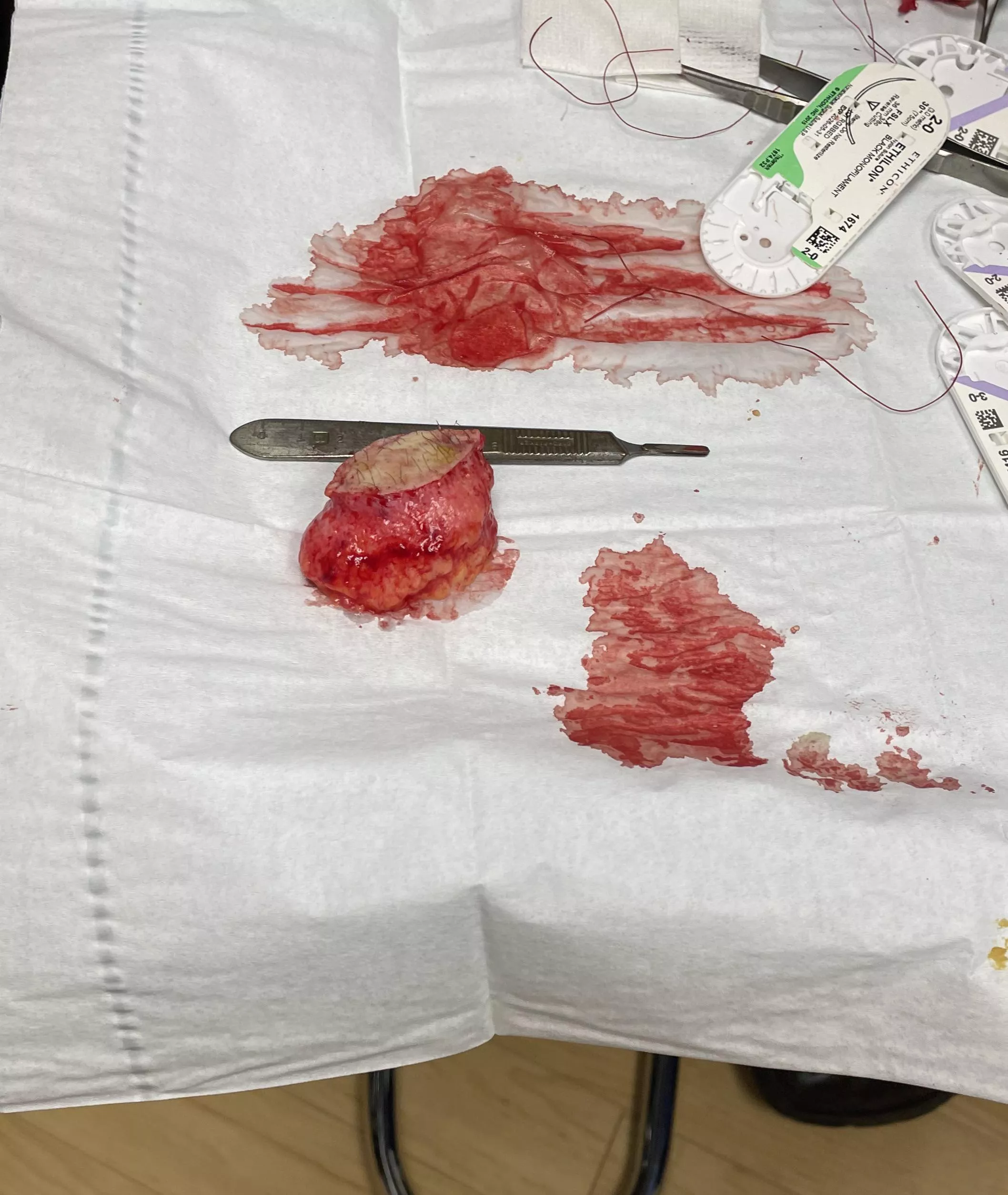 Sebaceous cyst removed posted by Purple_Pollution_256