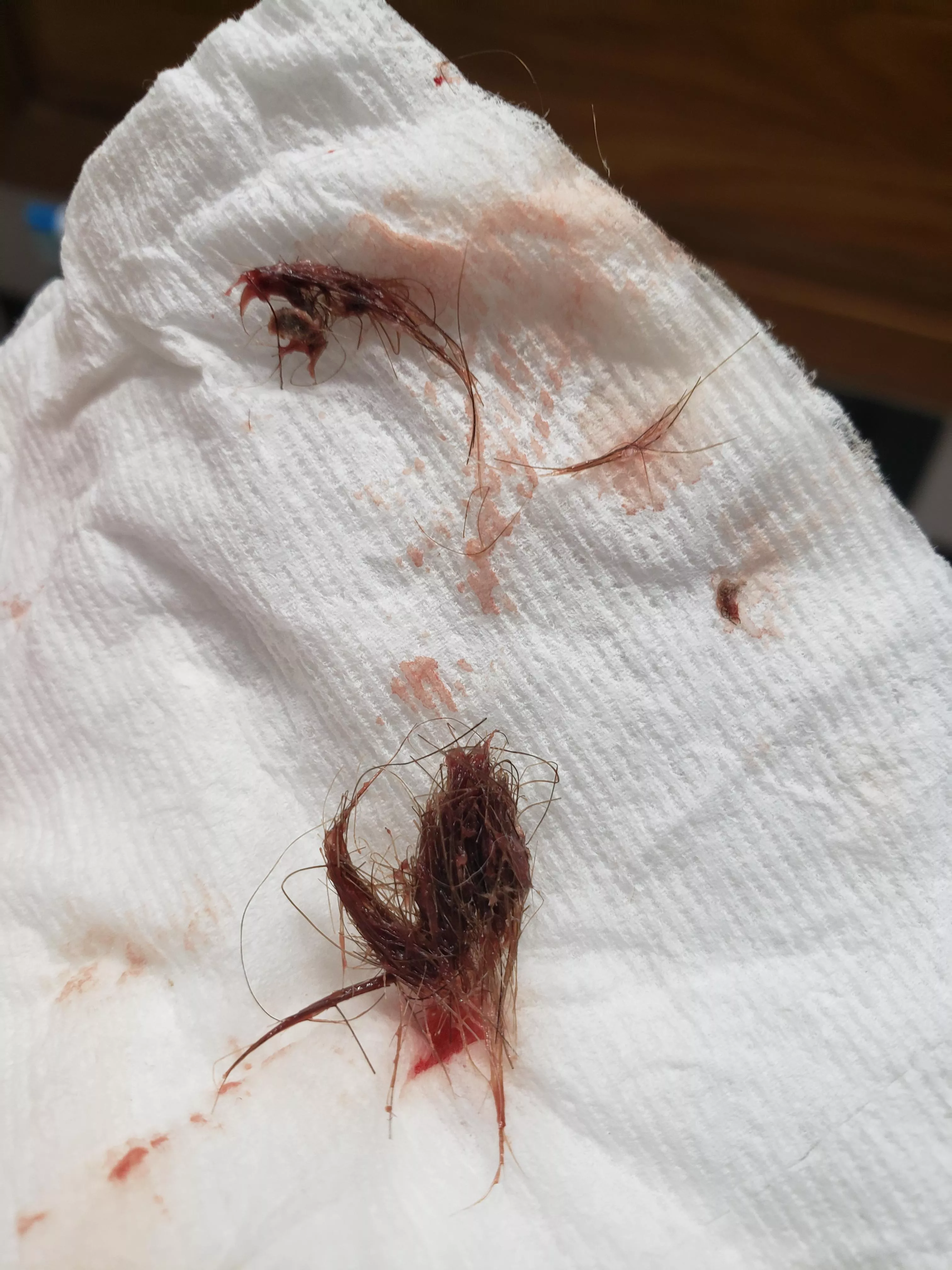 2 days ago my belly button began bleeding and had a slight discomfort sitting up and bending. It felt like it might have been a cyst. I put my finger in there and felt something, but couldn't quite reach it. Turns out it was a huge thing of hair? I've  posted by Jake1ender