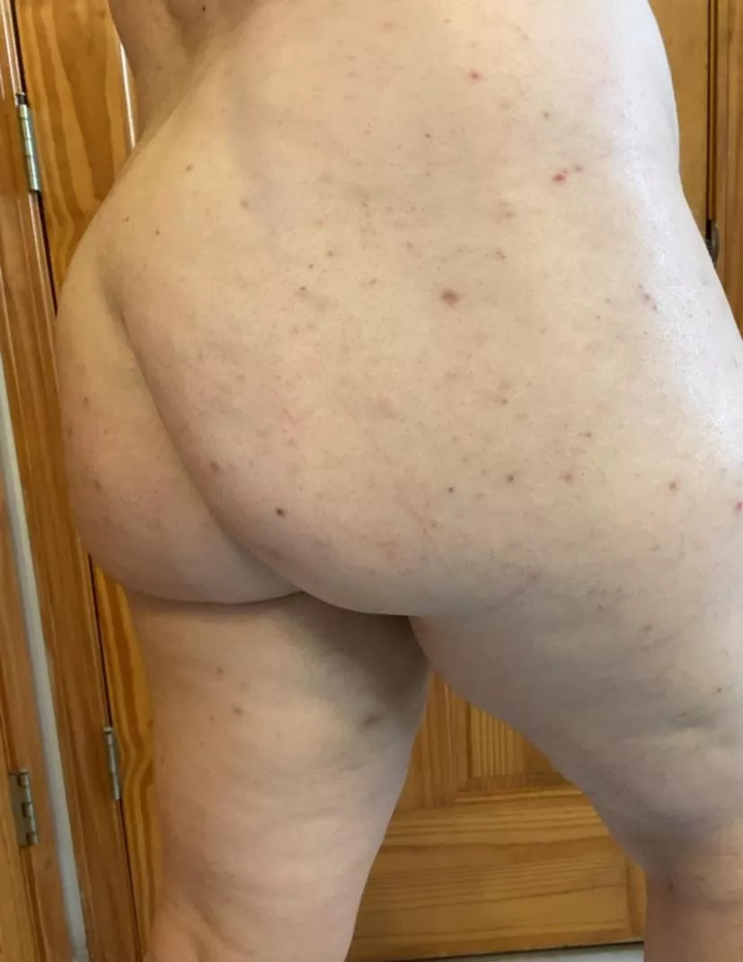 (28F 230lbs 5’5) I’m here to represent my people with spots all over our butts. Trying to overcome my hyperpigmentation problem! posted by kingyeehaww