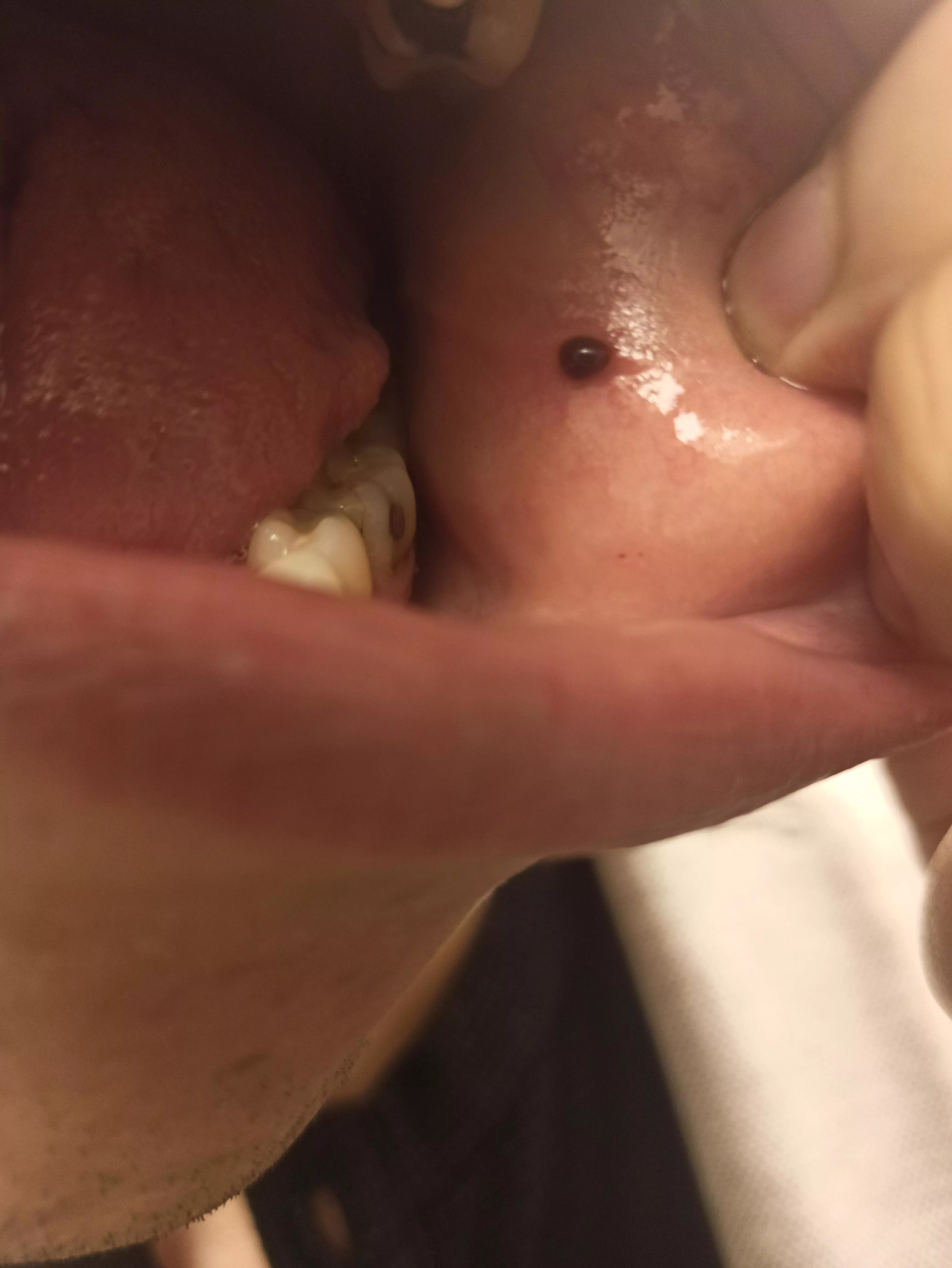 A blood blister in my cheek, should i pop? posted by ah-squalo