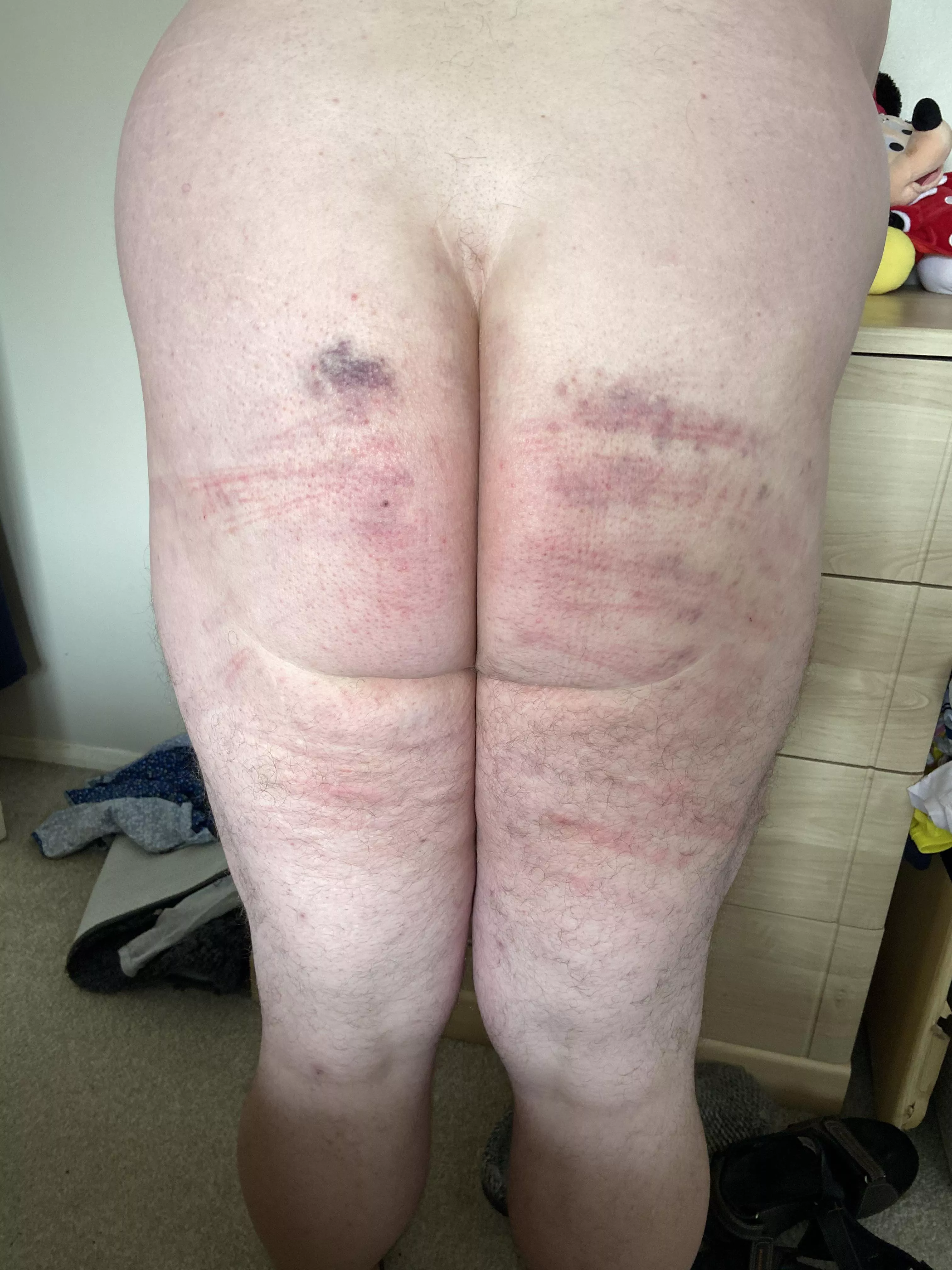 A day after my caning. Bruises coming out now. posted by JadeElf