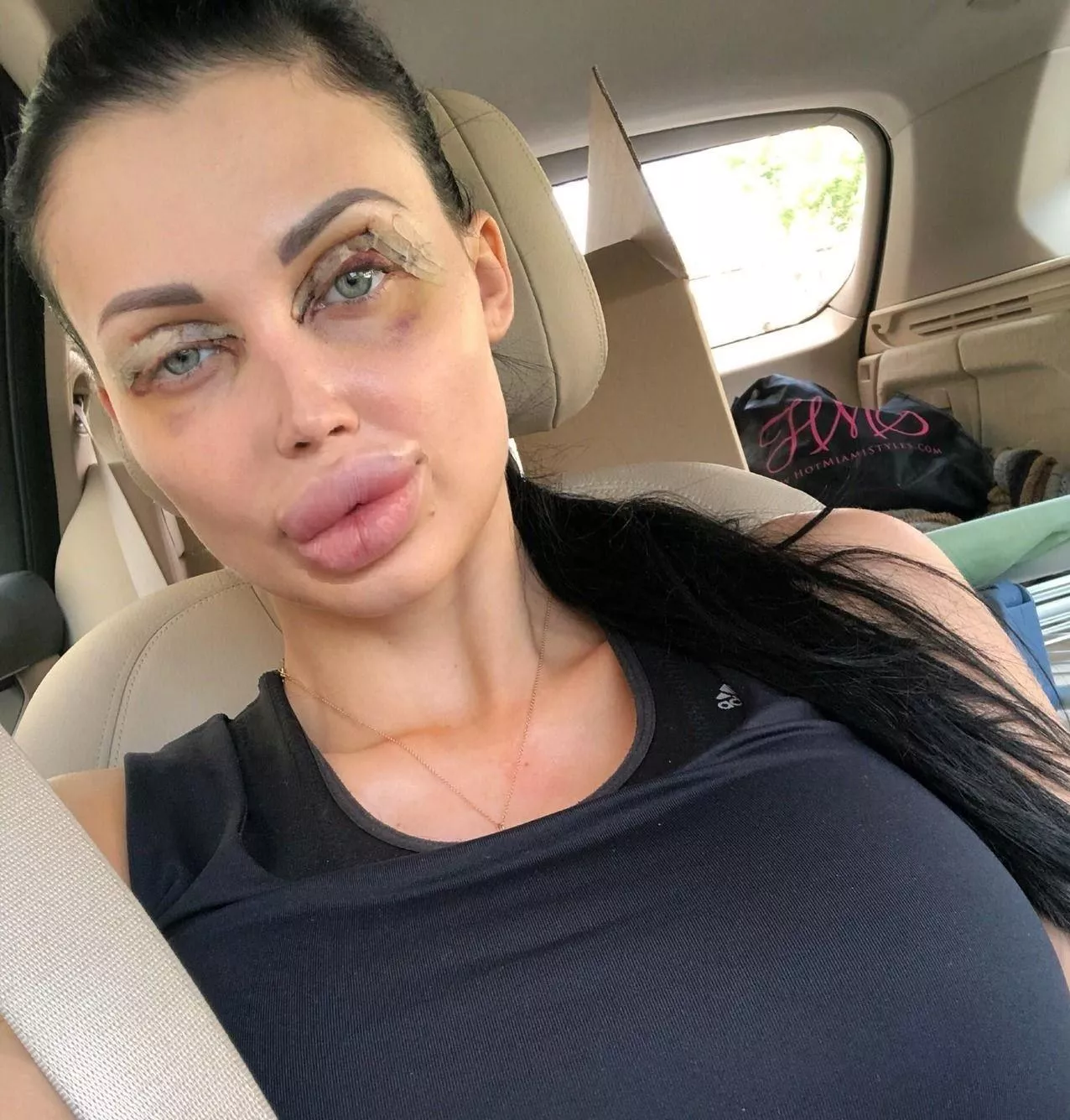 Aletta Ocean right after Surgery posted by k_luxe