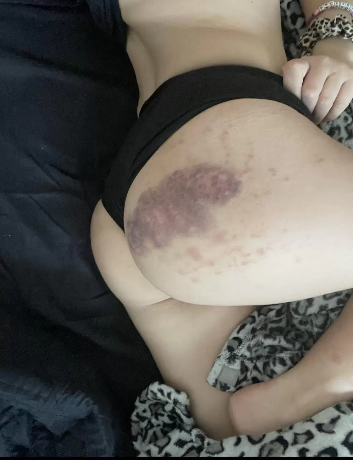 always admiring my spanking bruises ;) (f) posted by succubus_asura