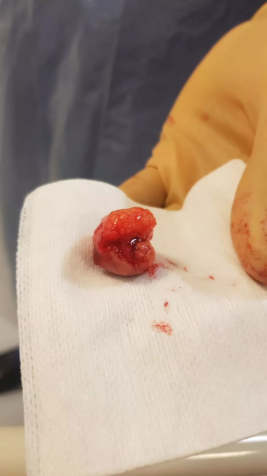 An intact cyst sac removed from my Dad's back today. posted by WallaceMacGregor