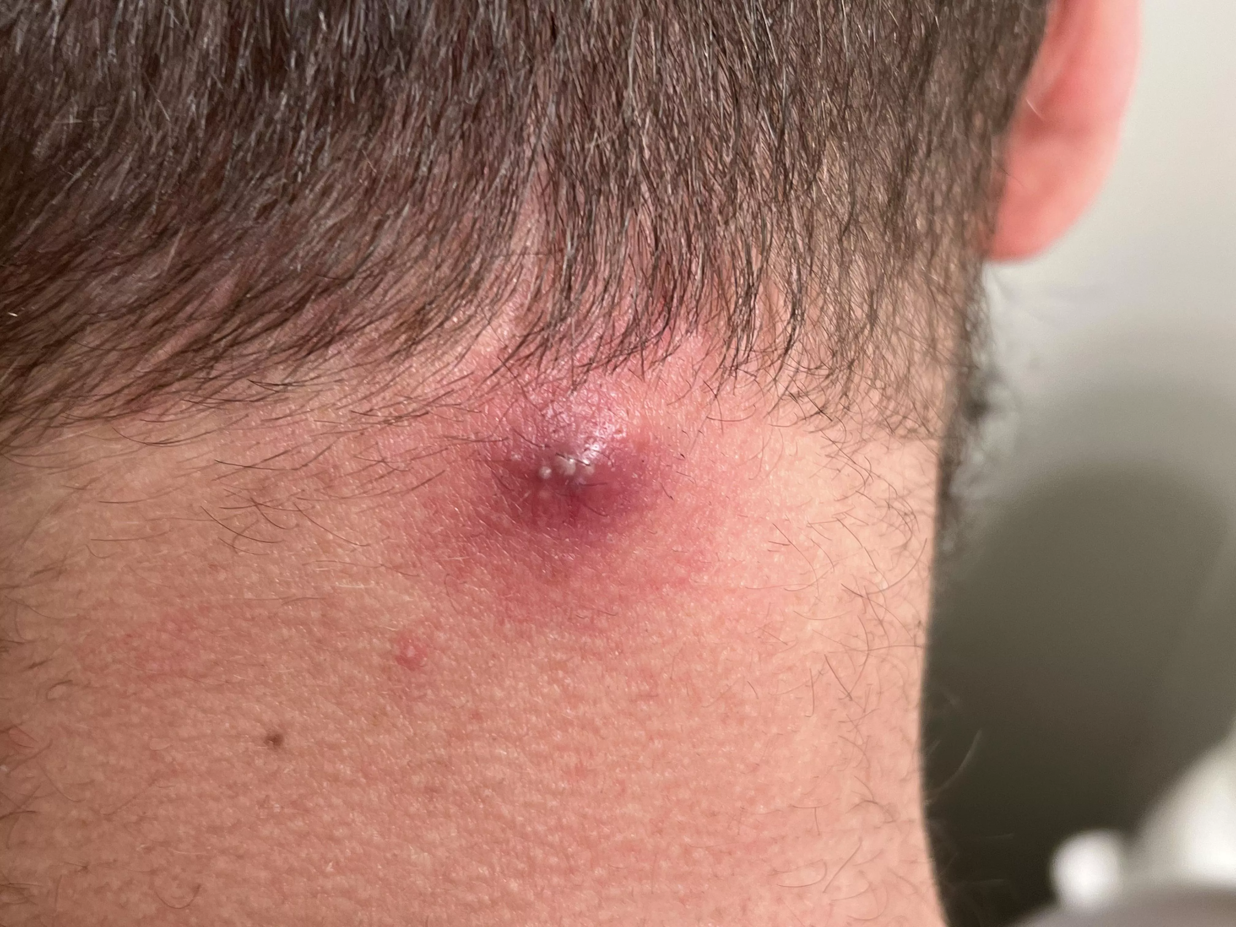 Angry boi on my neck from a year old cyst posted by flickerdown