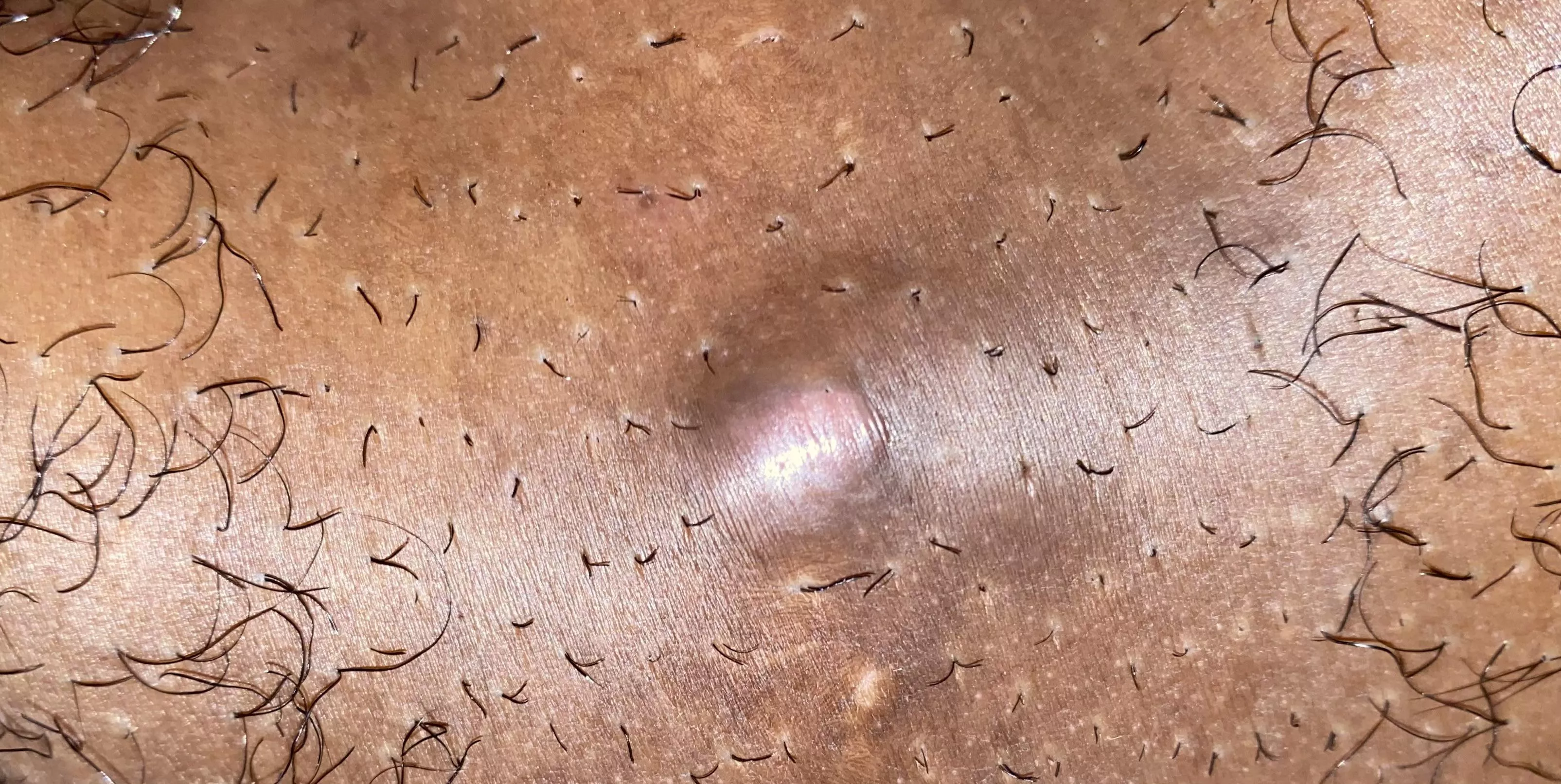 Anybody have any idea what this could be? Thought it was an ingrown hair but I pulled small ones out and its still here. Maybe a cyst? In genital area. posted by KaliLovee