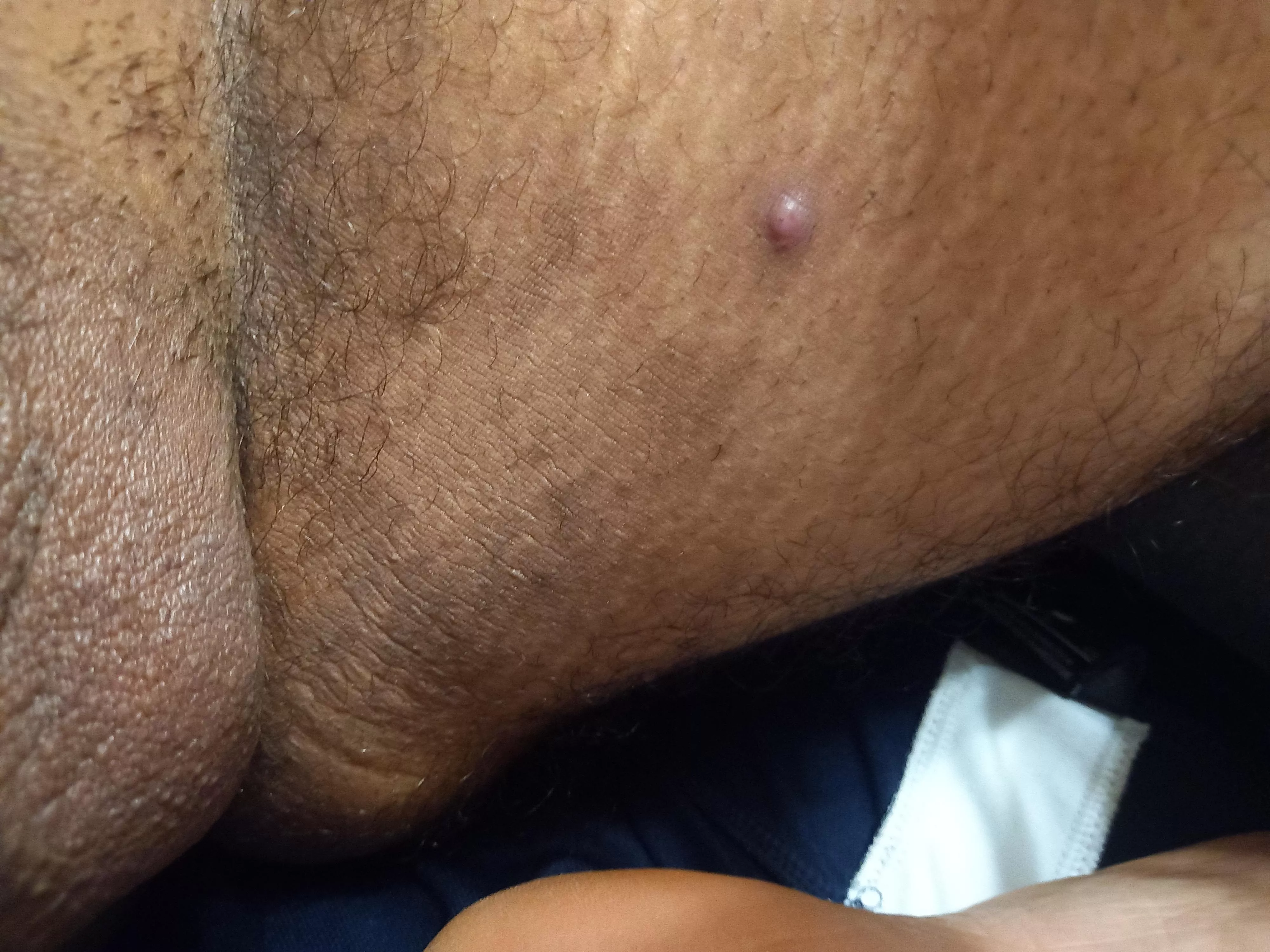 Anyone knows what this spot is, it hurts when I touch it. posted by Necessary_Airport_74