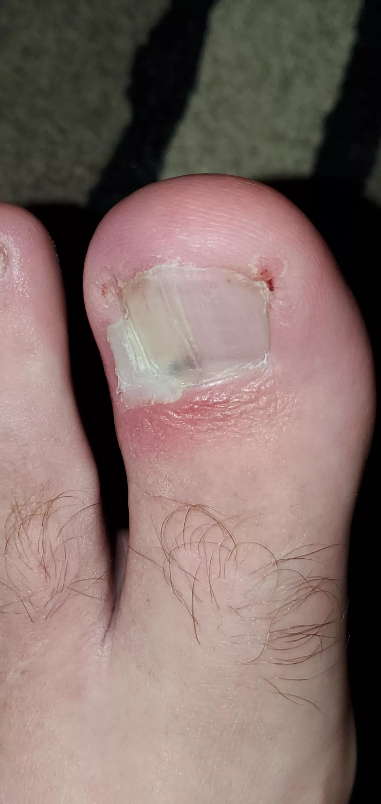 Been in pain for over a week, finally decided to soak my foot and see if I could pull this ingrown nail out... This was the aftermath. Instant relief with some puss and blood. posted by deeeezzzzzzzznuts