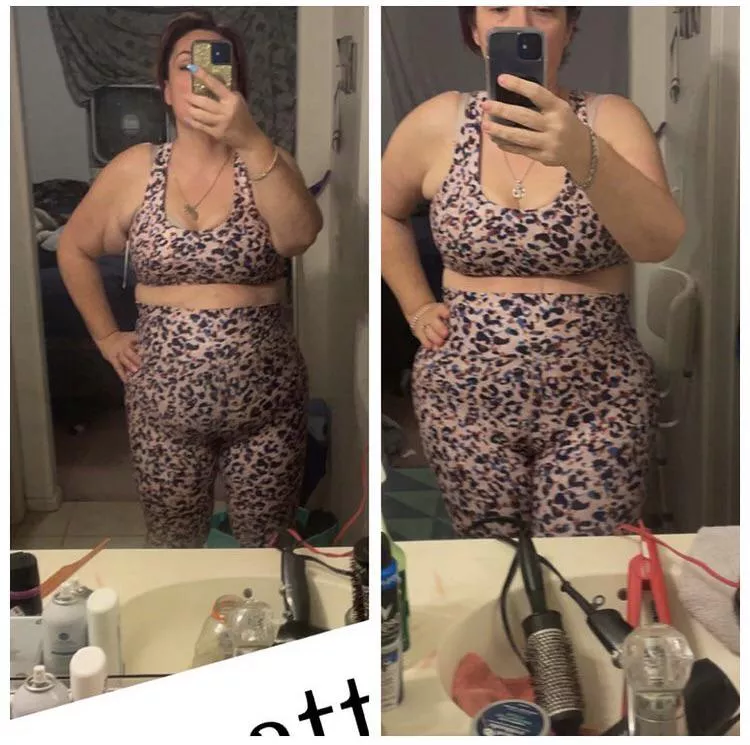 Before and after surgery posted by Resident_Tone_313