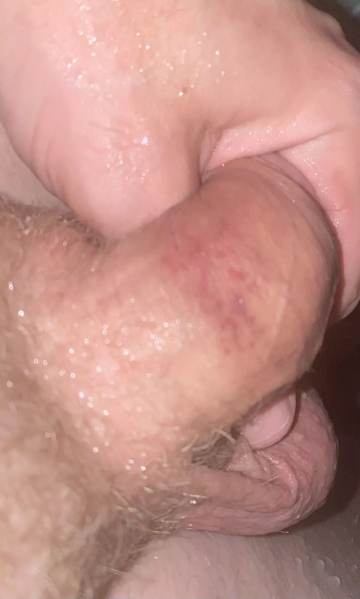 Blisters/irritation from pumping posted by upcurve