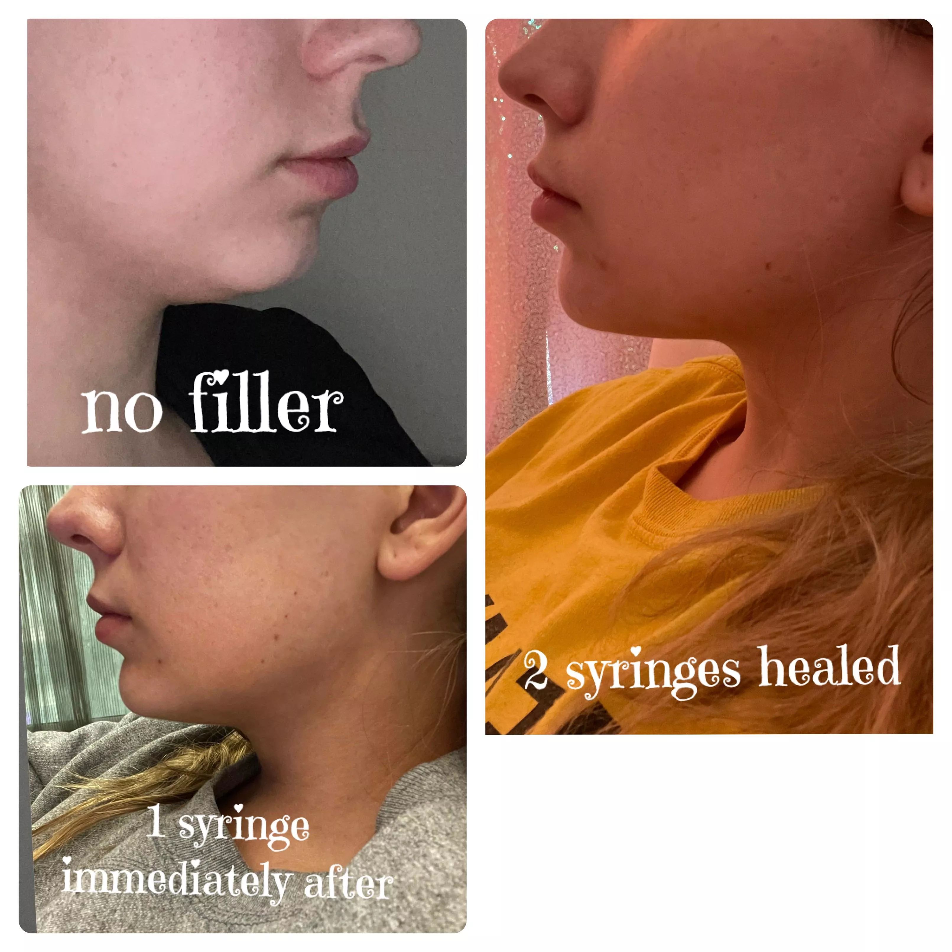 Chin Filler Progress! Balance is so important 💕 posted by slutmeup