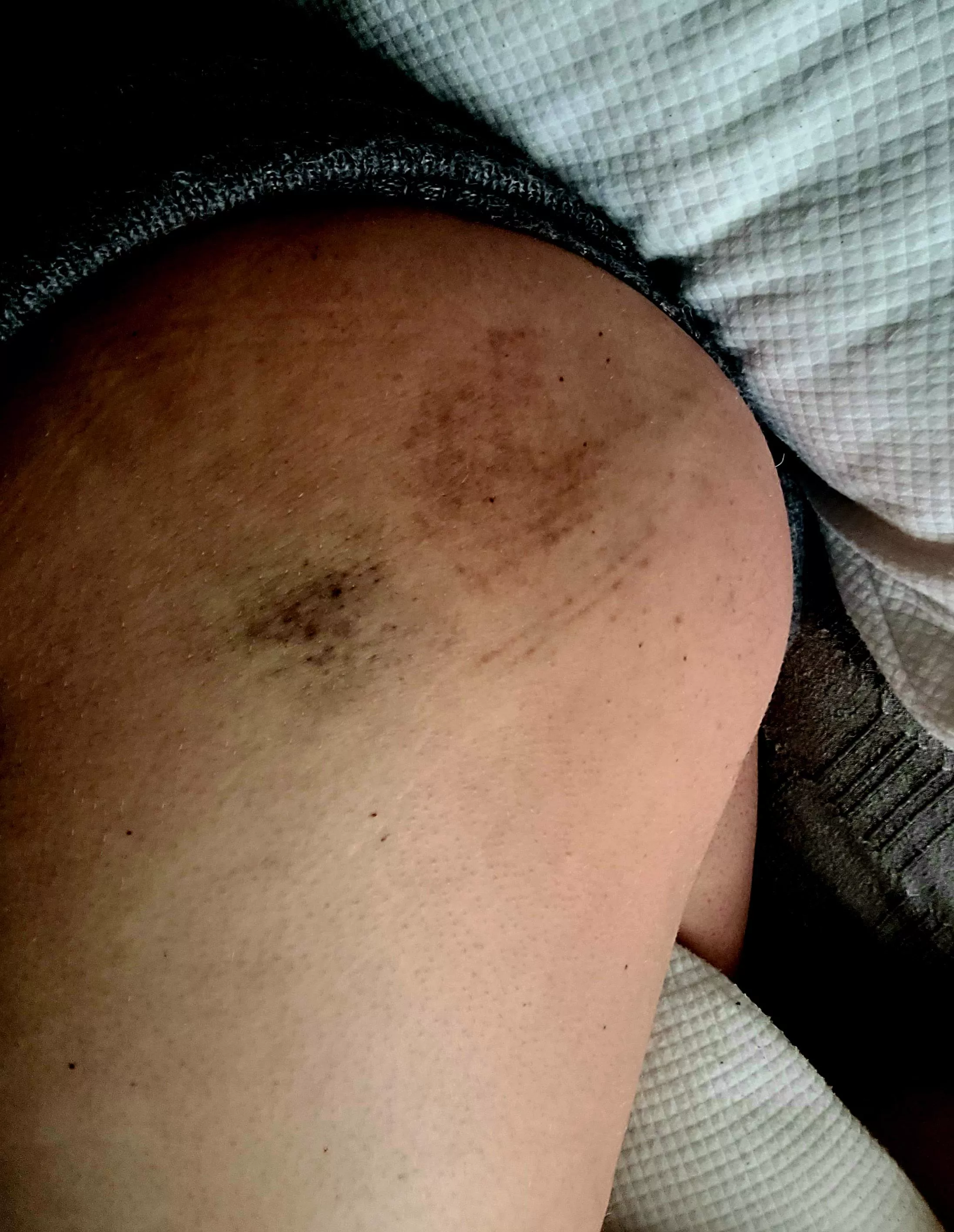 Day 3 of bruising ðŸ˜ˆâœ¨ the other butt cheek got at good round of spanking today posted by frkmbuh