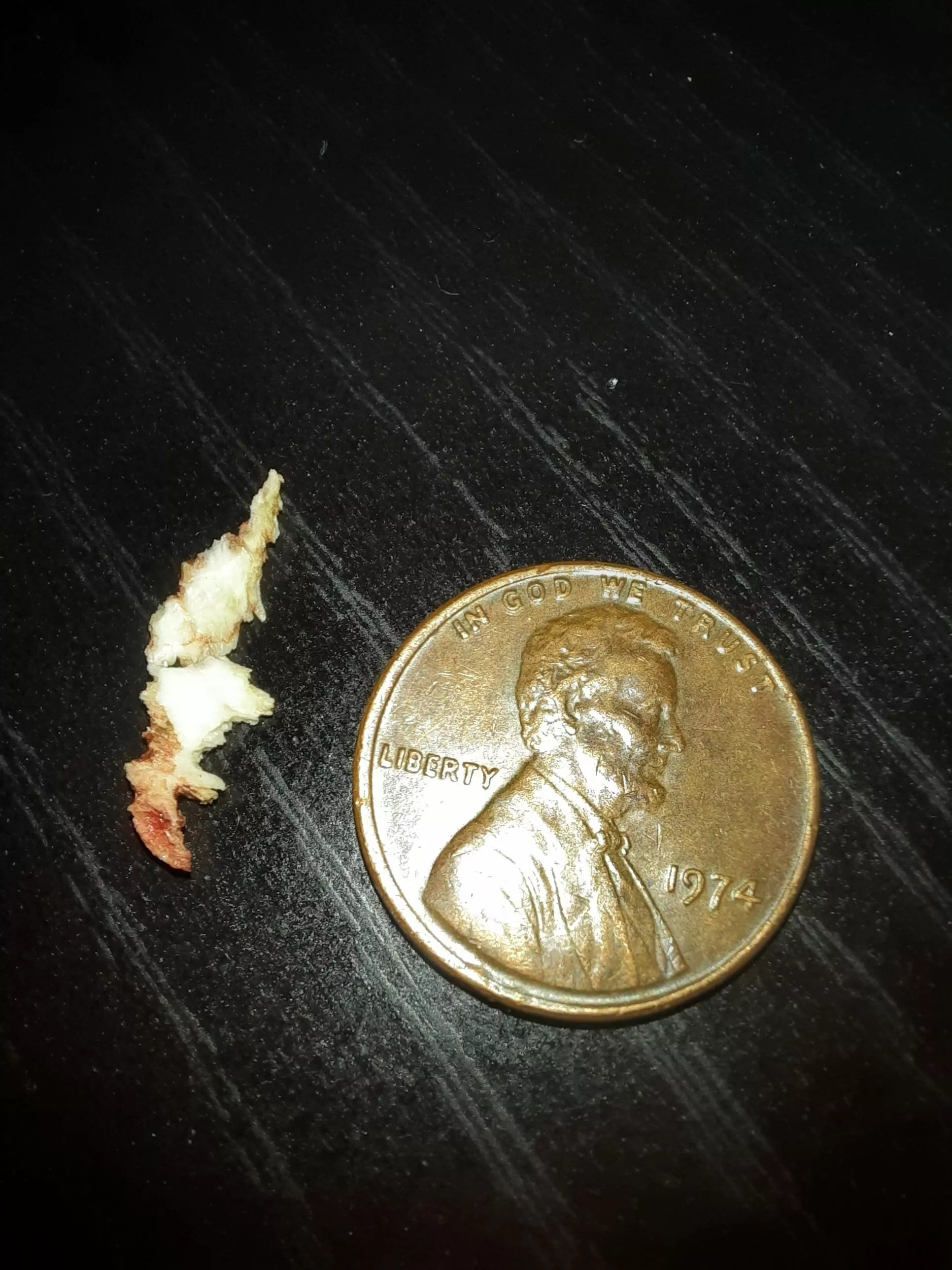 Dental sequestrum I pulled out 2.5 months post-op from infected wisdom tooth extraction site posted by mactofthefatter