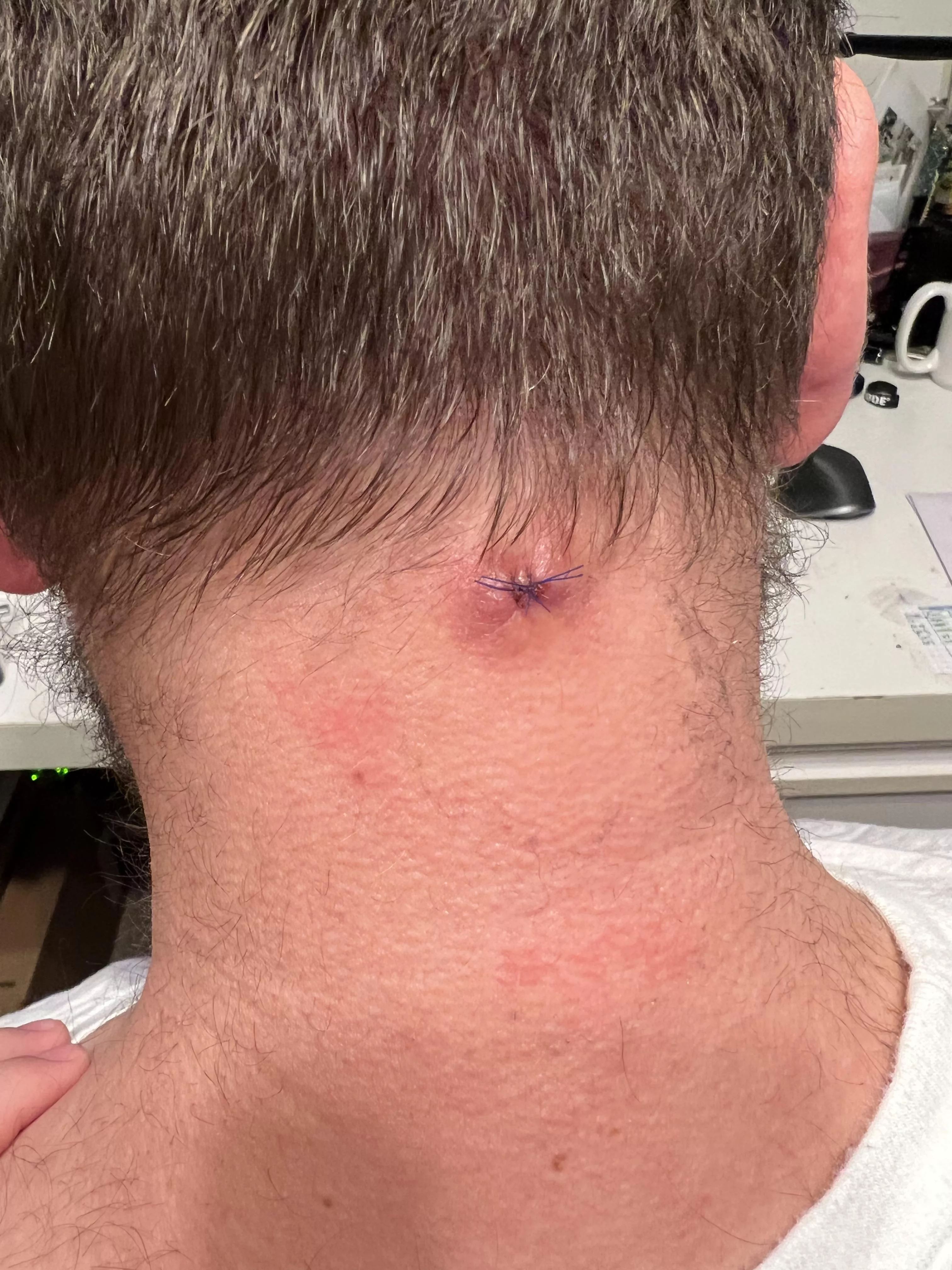 Diagnosis is…folliculitis! (And now I’ve got the stitches\scar to prove it) posted by flickerdown