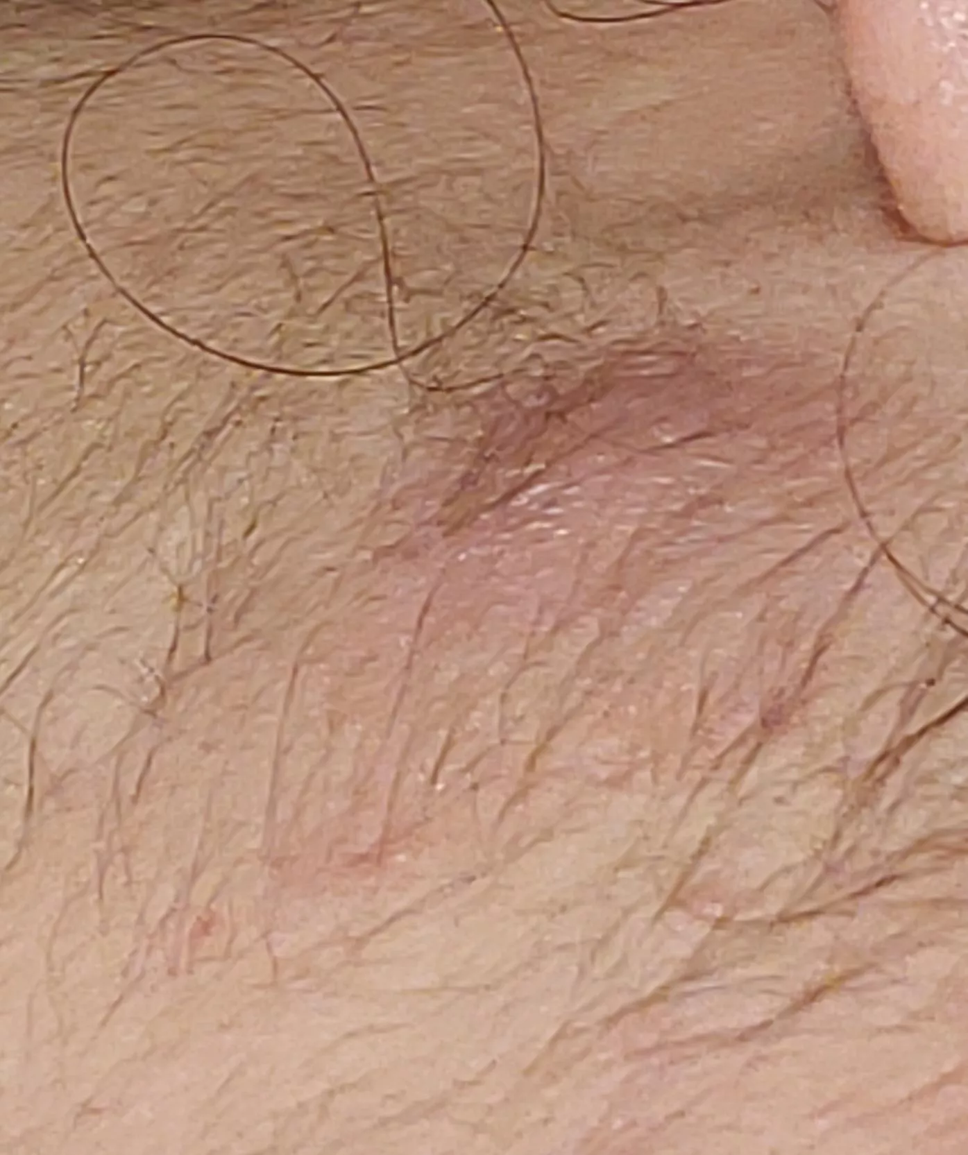 Does this look like a cyst or boil? Getting it checked out hopefully next week by a doctor. Can't seem to find a head on it but it's swollen. Delete if not allowed. posted by Exact-Purpose-8219