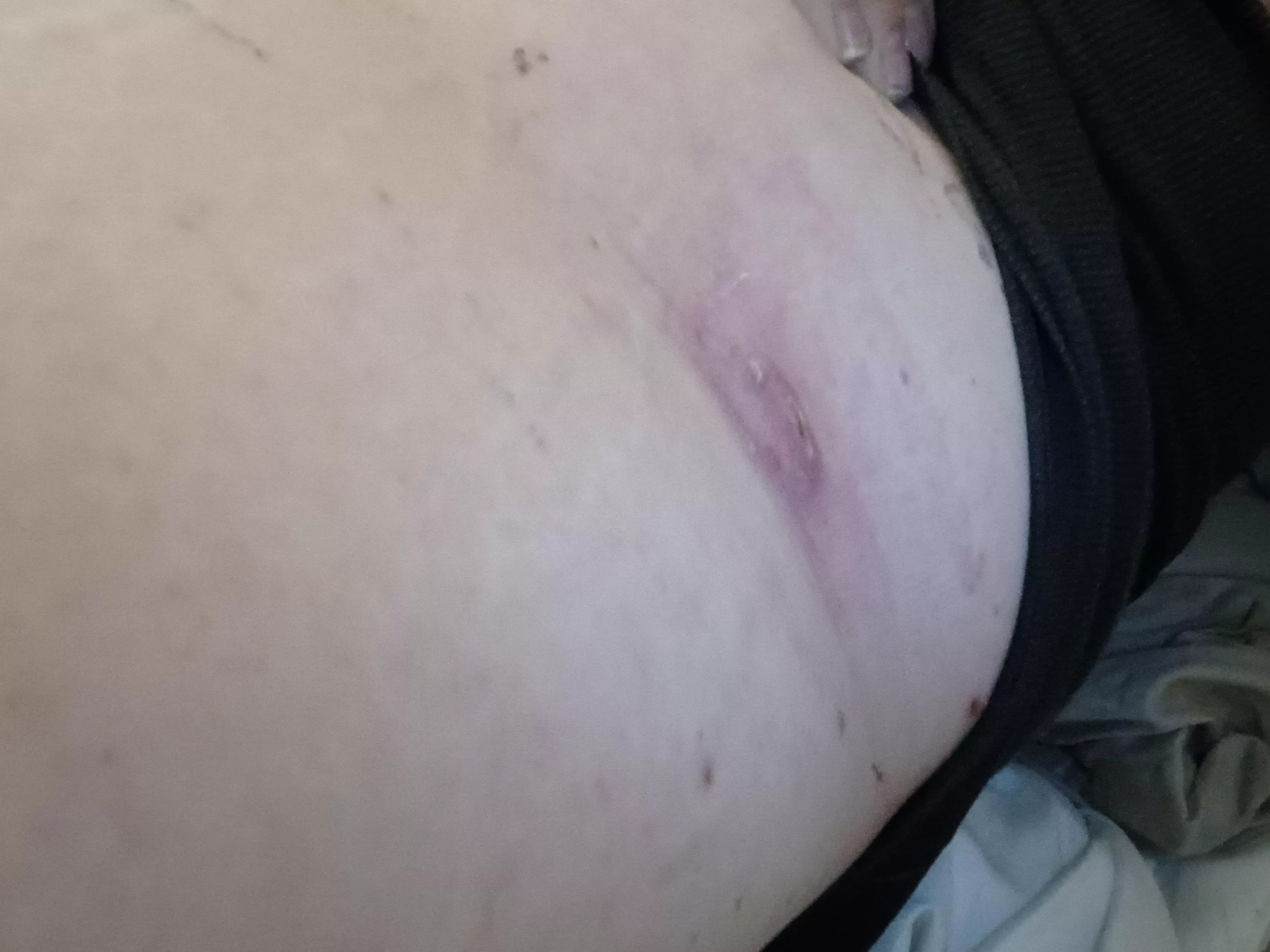 Double headed boil on my back, went to urgent care as it was super angery/ infected and earliest appointment with my derm was February. They lacerated it and drained it. 2 weeks of 2 antibiotics only to realize they didn't even take out the sack. Guess  posted by damndolly