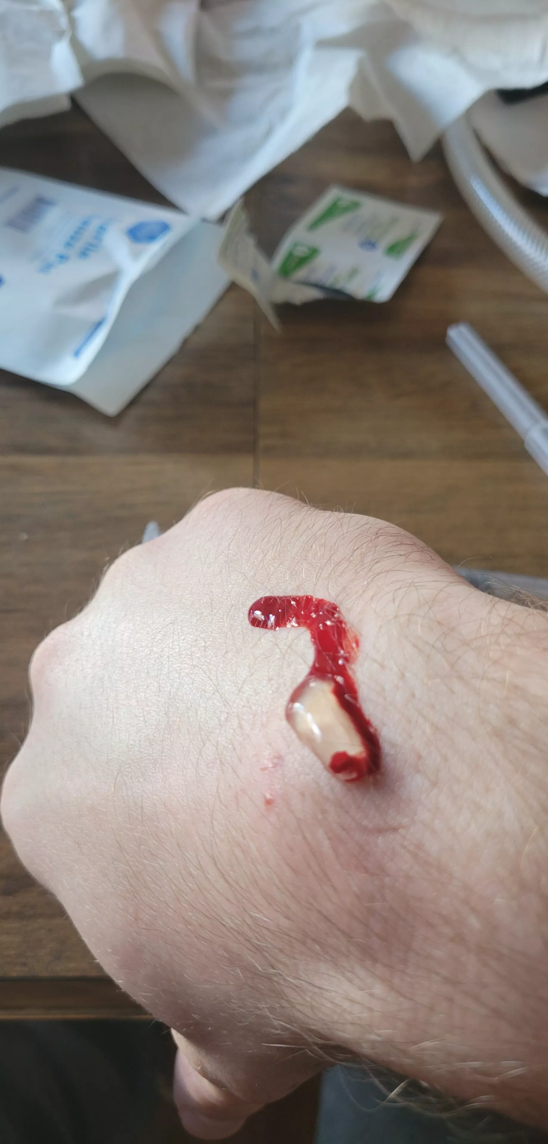 Drained the ganglion cyst on my wrist. Nobody could stomach filming it so here's the aftermath posted by n0st3p0nSn3k