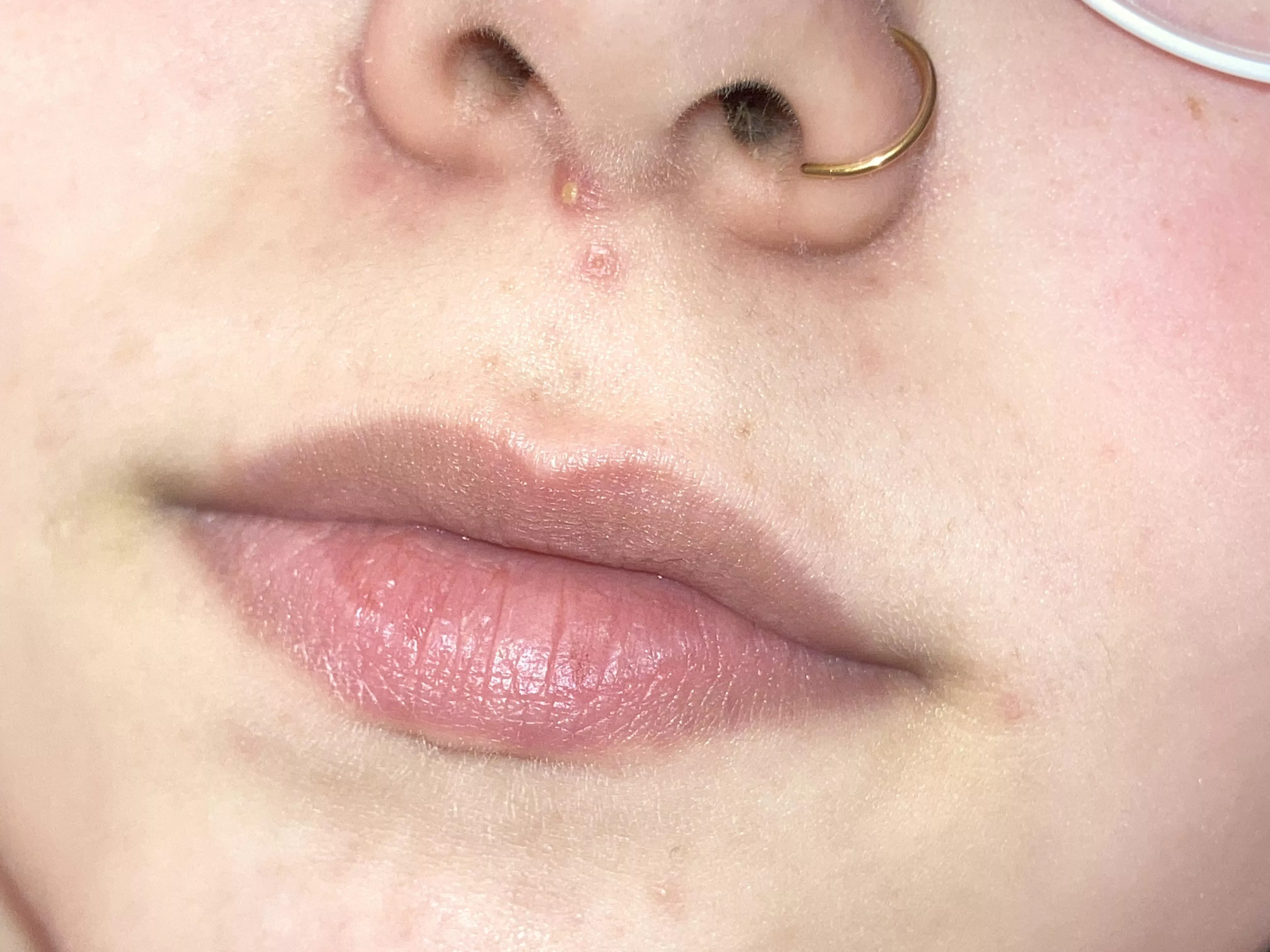 Eczema and acne after coming off the pill, forbidden pop because it hurts to sneeze/triangle of death :( posted by prayformeiplead