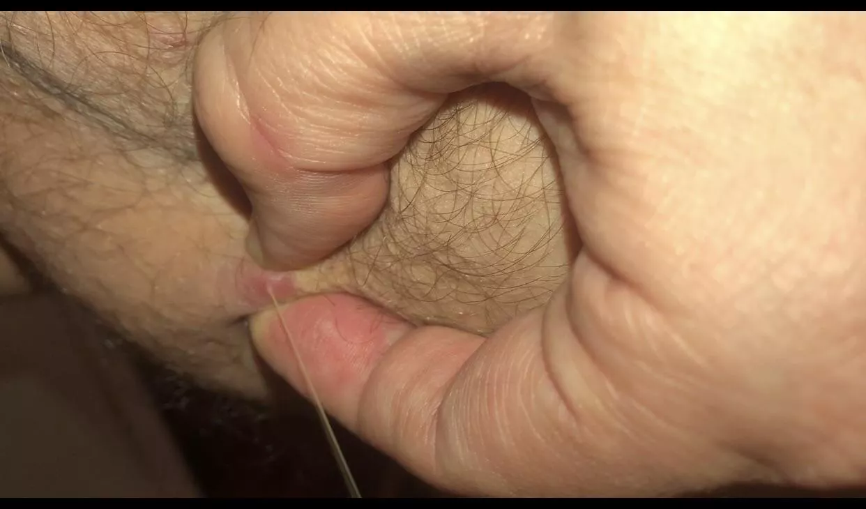 Epic pimple found on my inner thigh yesterday. This is a Screenshot from a longer video, let me know if you guys want me to repost it. Projectile much? Forbidden milk. posted by aussiethrowaway1985