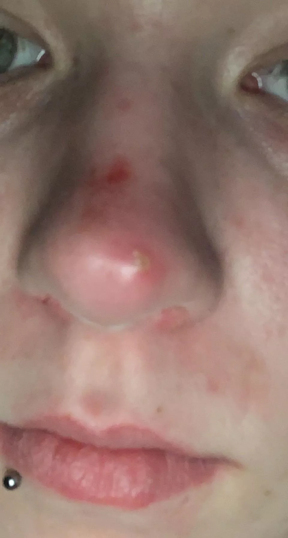 First post: had a giant red spot on the end of my nose for a week or so and while at work it started hurt whenever my mask rubbed it and then I see this beauty posted by Deadlove1415