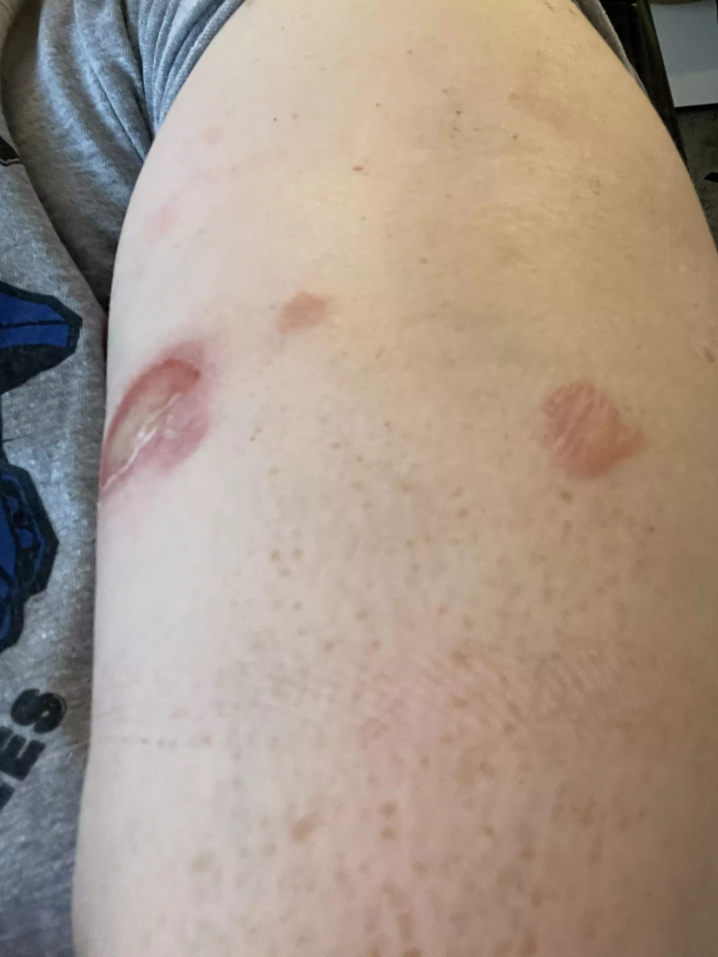 (First post/OC) Forbidden pops! Burns from boiling water, just removed the dressings posted by dudehawkeye