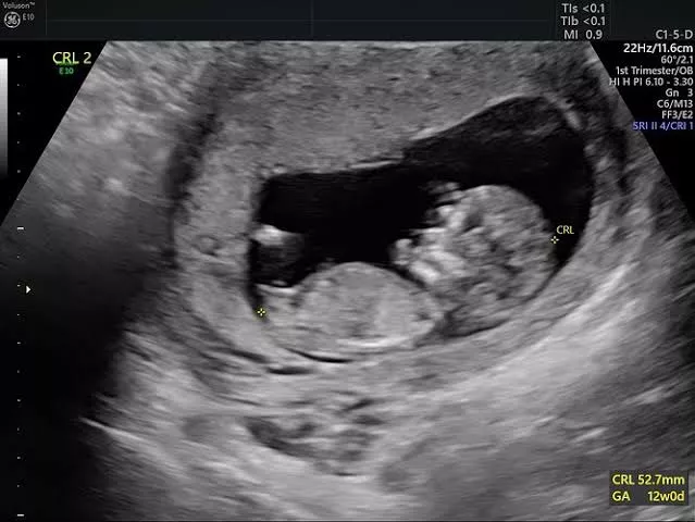 #First Pregnancy scan.. Sharing my wife's first pregnancy scan report to all the beloved users here. Her bull impregnated her on December and she is now carrying his seed. I am truly excited to get this first scan report.. Dream come true moments of my  posted by Due-Welder-8347