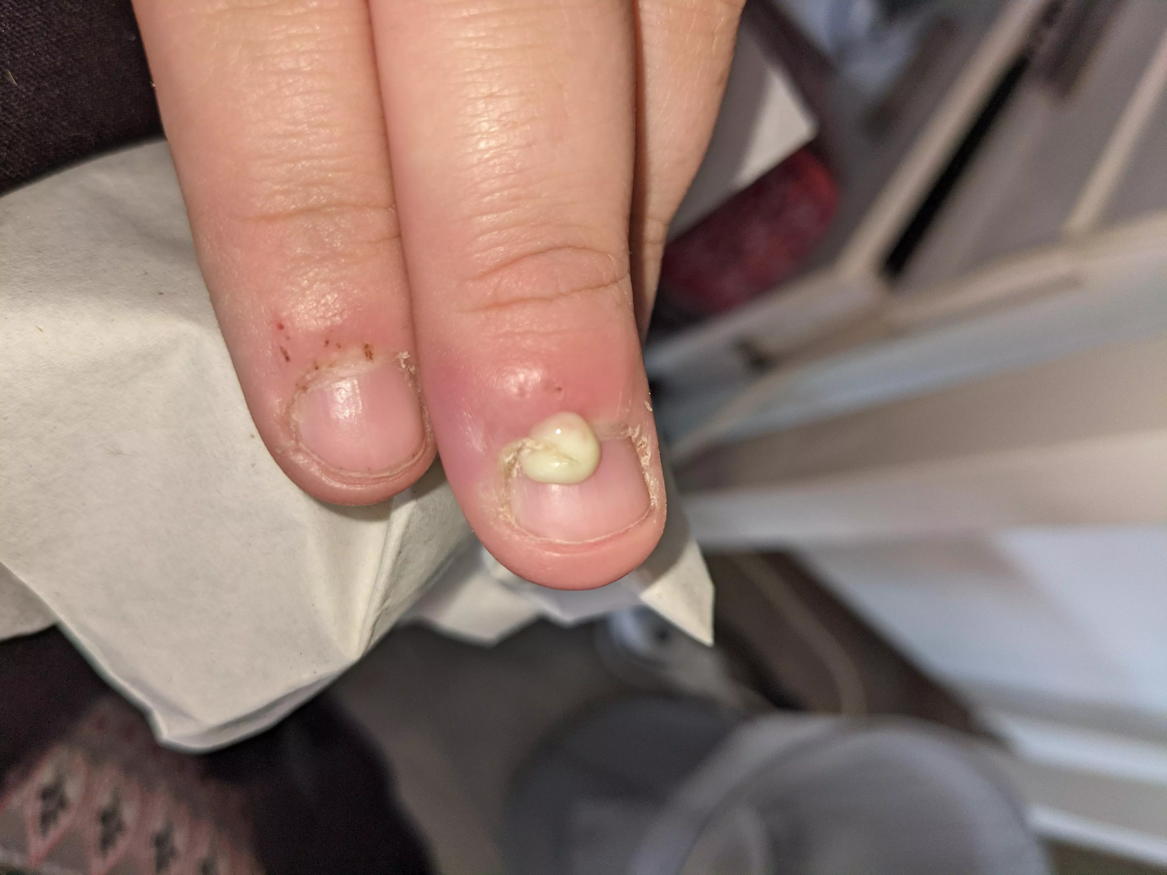 First submission! Post-pop of a cuticle infection (accidentally, would have recorded if I knew it would pop today) will provide update if more comes out later 😂 posted by xCatChan