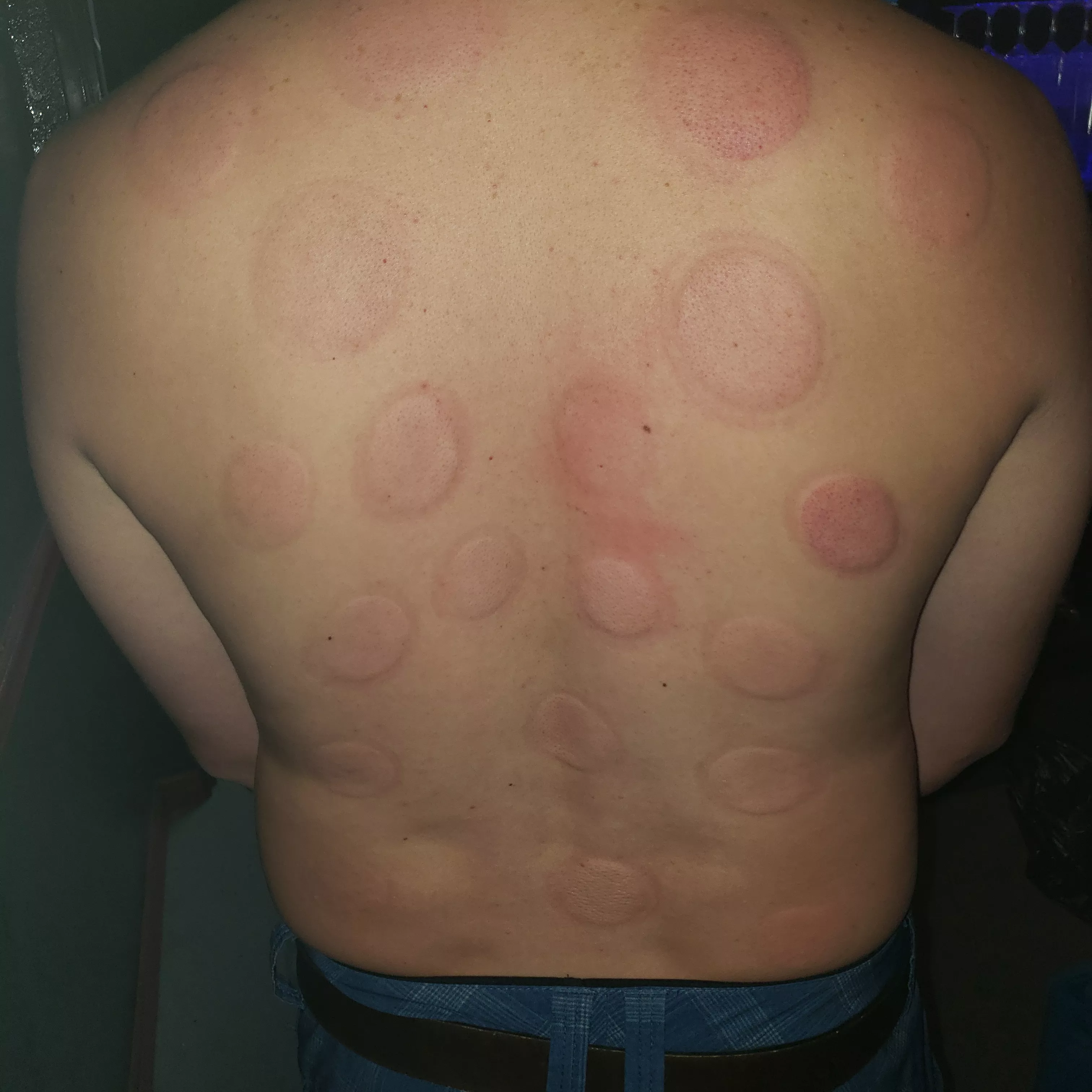 First time fire cupping! One of my favorites posted by kazary199