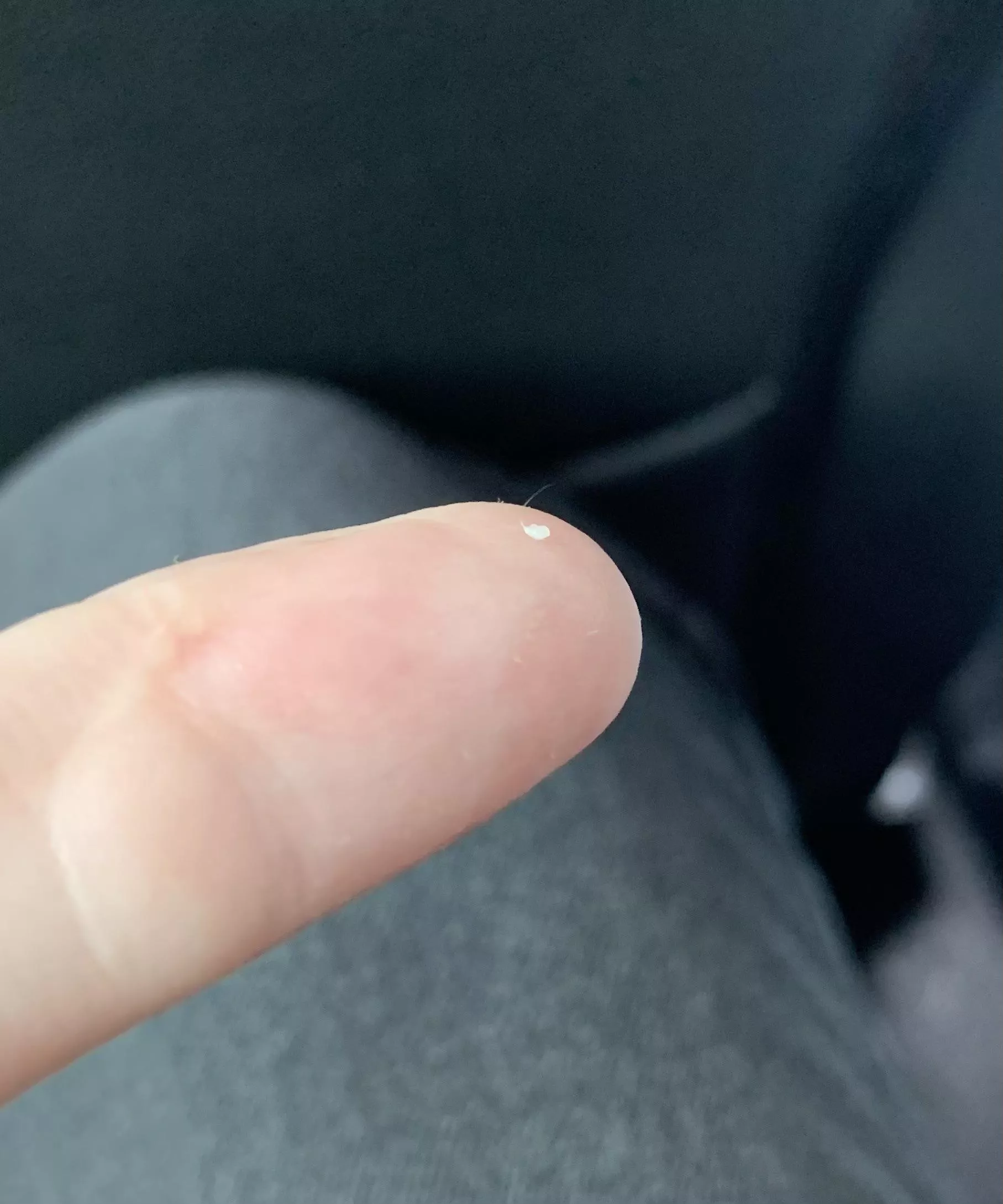 First time posting. Got this little guy out of my shoulder. You can just see the hair in it. posted by GemHatesStarWars