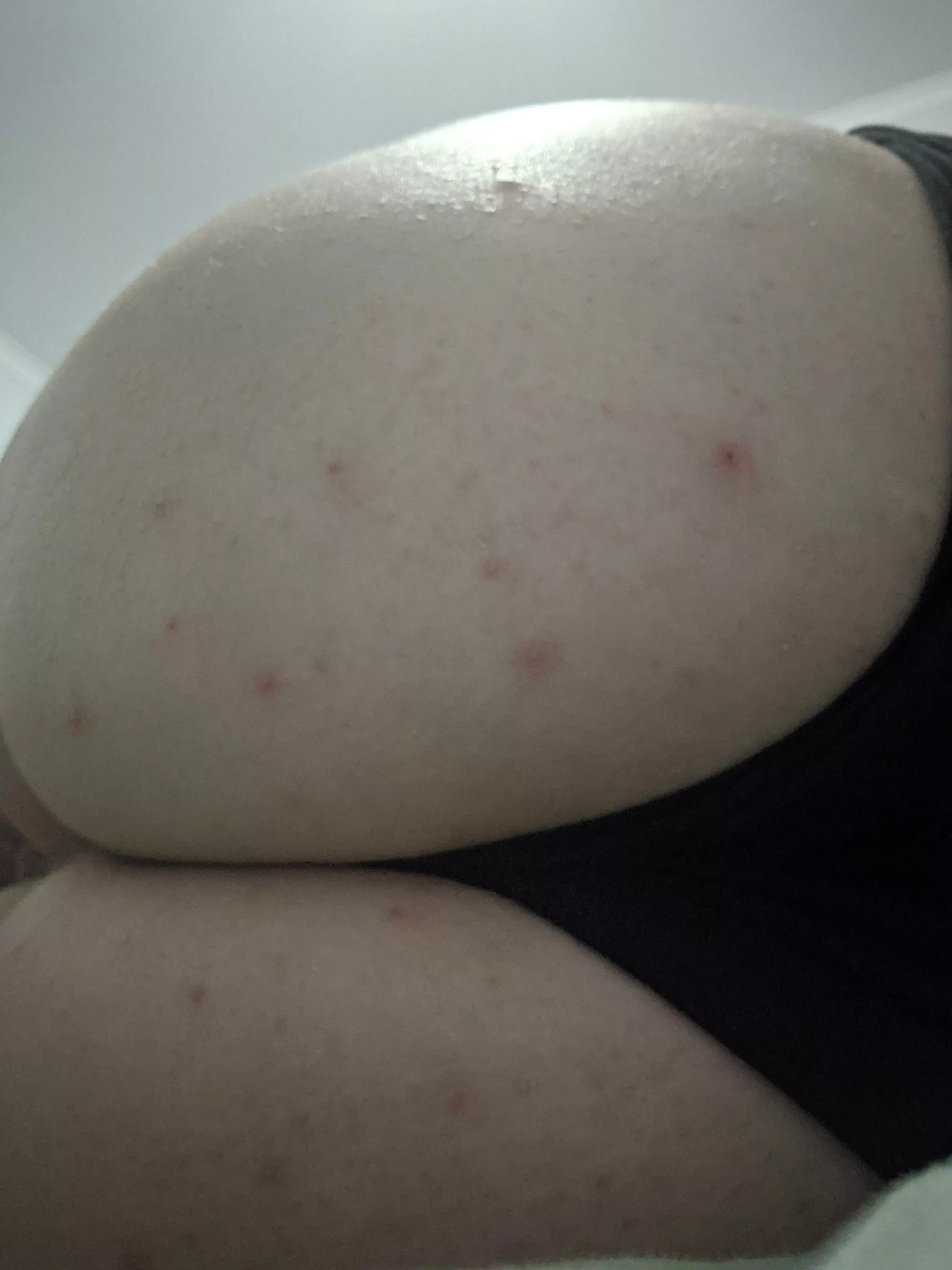 For some reason I keep getting butt pimples. NSFW because butt. posted by Micklebumbie