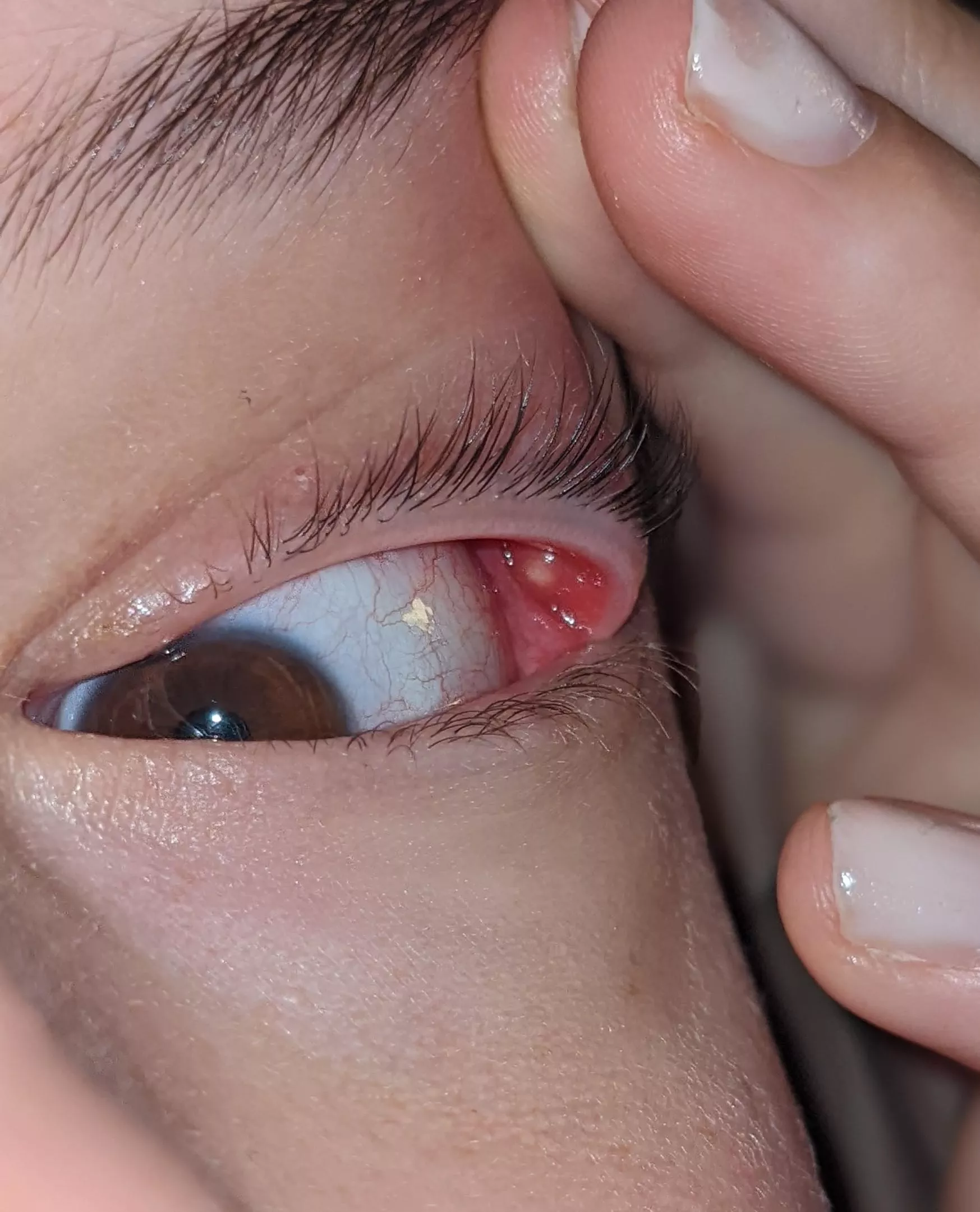 forbidden pop- 4 day old internal stye. i hope to god it goes away soon. posted by butdoyouhavelambda