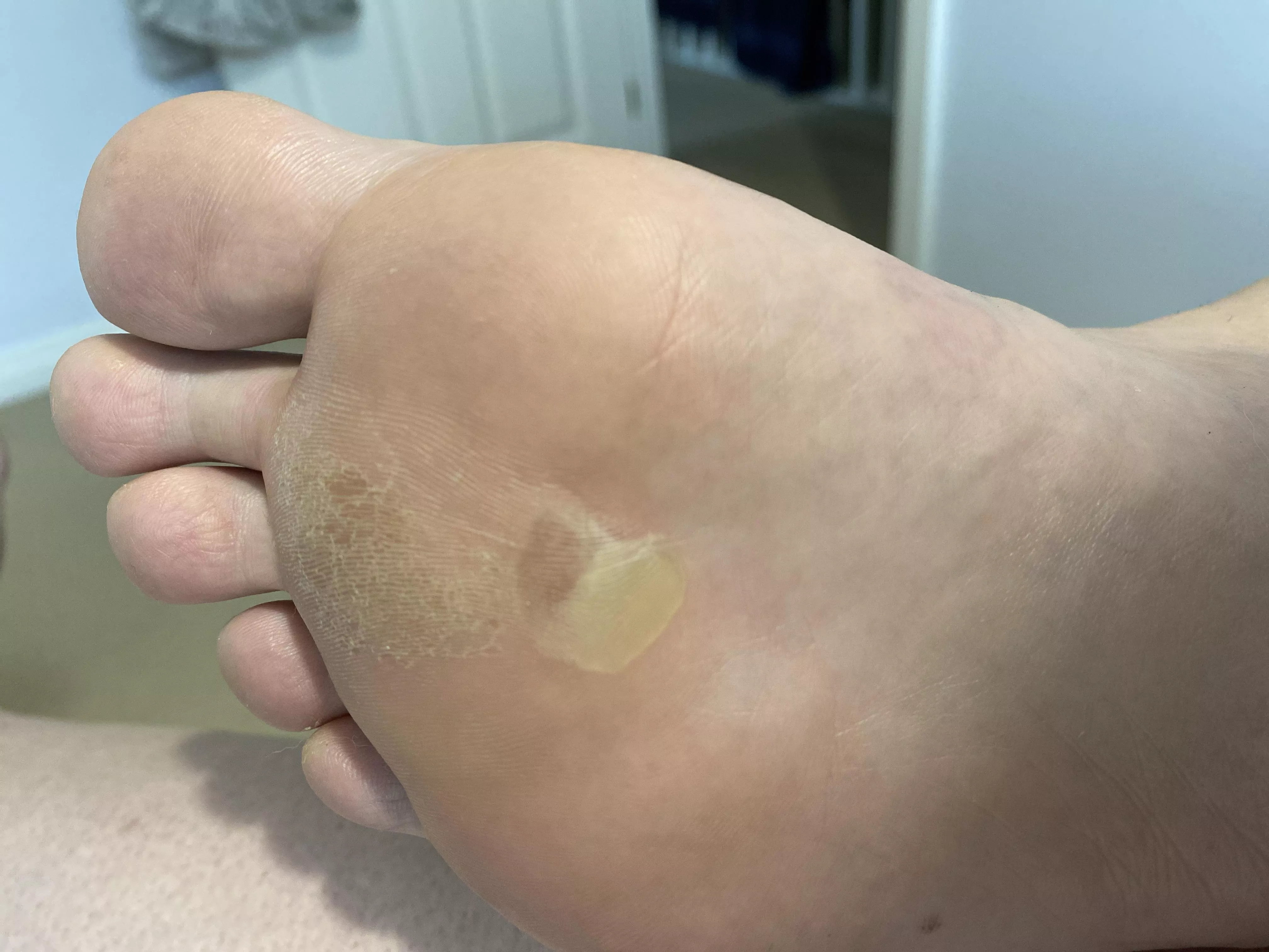 Forbidden pop - blister on a blister on my foot. Sucker hurts like hell! posted by hereforthefreeshiz