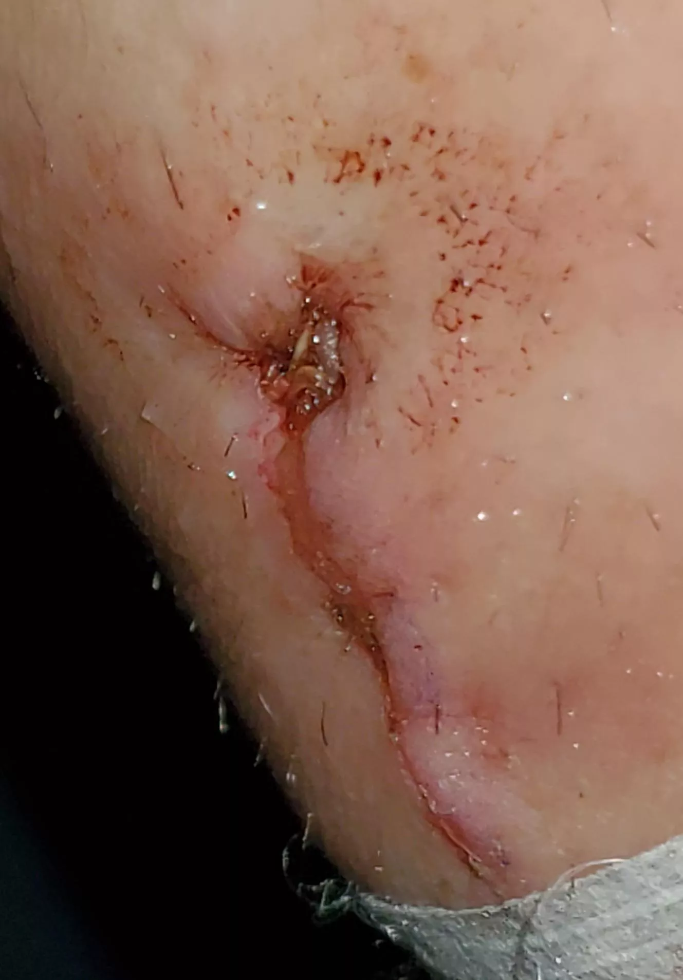 Forbidden pop. Had surgery last wk. Wrist area. It is so hard not to touch now that it's uncovered. posted by aghostofme