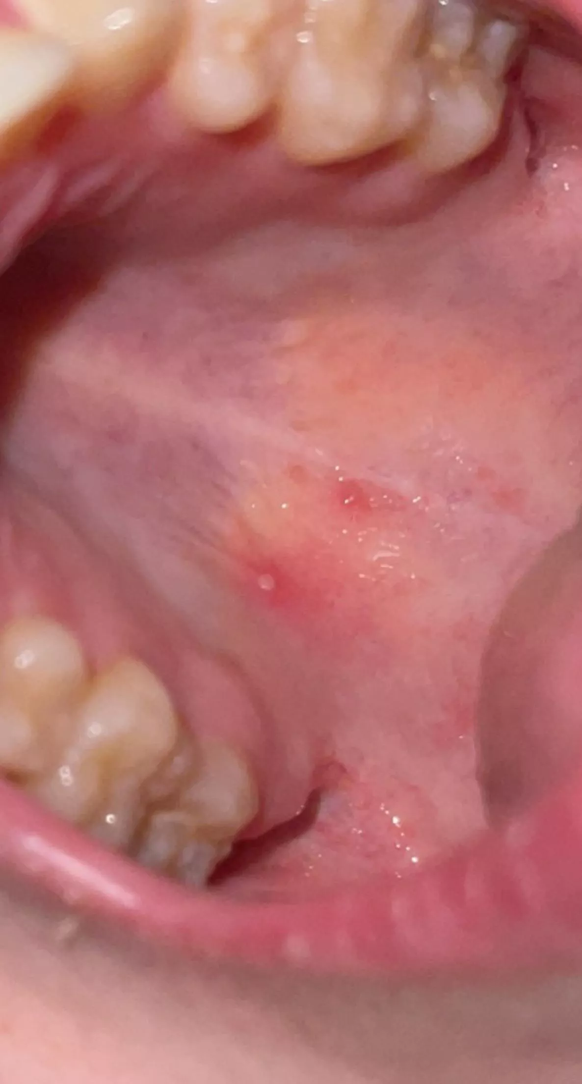 Forbidden pops in my mouth. Oral herpes flaring up posted by legolasisamanwhore