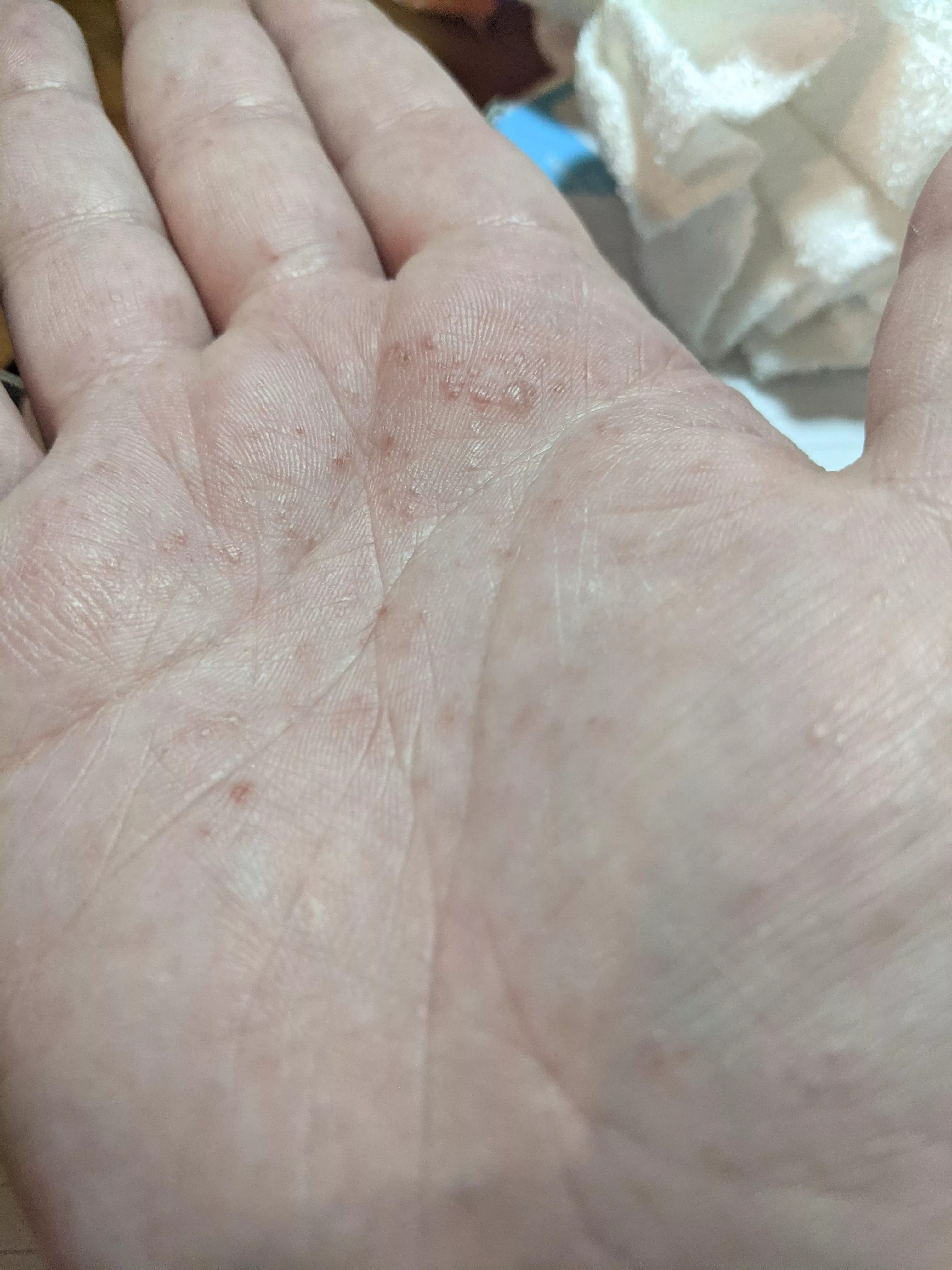 Forbidden pops in the form of Pompholyx Eczema, both my palms and sokes of my feet are covered, the itching is torture 😭 posted by mellymooooo