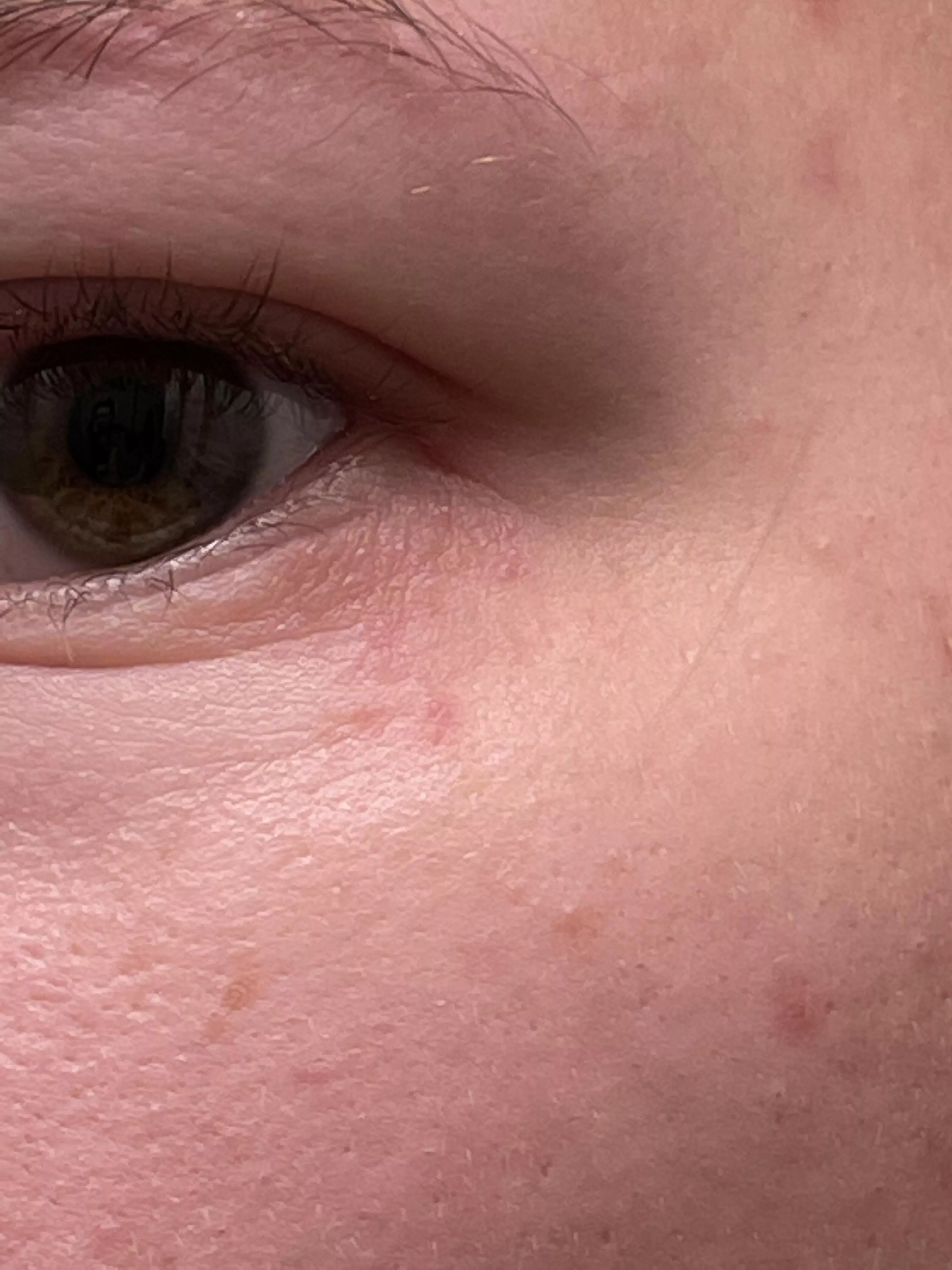 Forbidden pops under my left eye. Any idea what these are? They’ve been here for weeks. posted by legolasisamanwhore