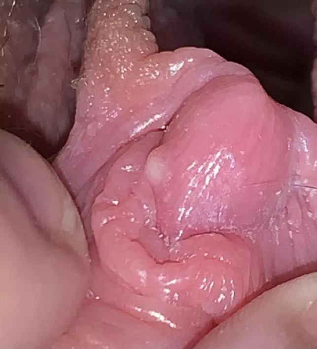 forbidden whitehead, LITERALLY on my clit. not painful or bothering me at all but i KNOW IT’S THERE and it’s driving me nuts posted by tealanura