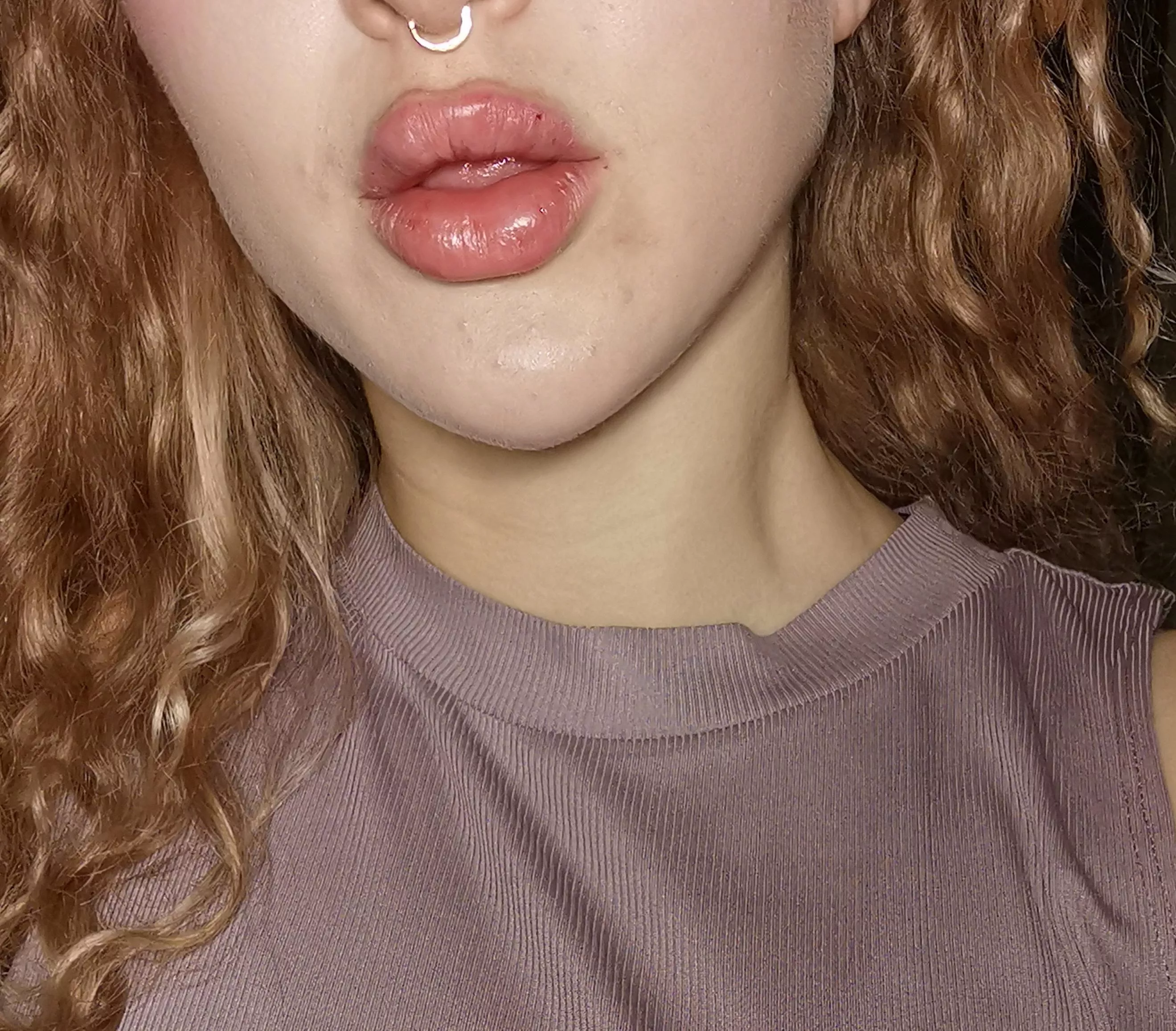 Freshly done lip fillers (there're still some scabs at the injection points) - literally the best feeling ever posted by miss_danaX