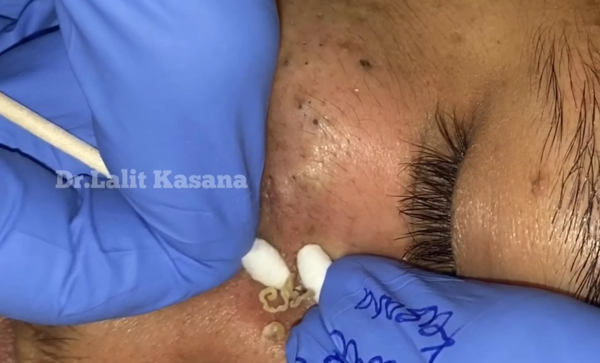 Goldmine of deep Blackheads (Dr.Lalit Kasana) It’s a repost but we’ll worth another watch! Link in comments.. posted by Hunni_Bee