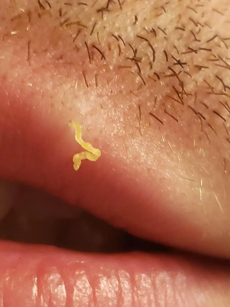 Got more than I was dreaming of with this blackhead on my upper lip posted by Ancient-Egg-3283