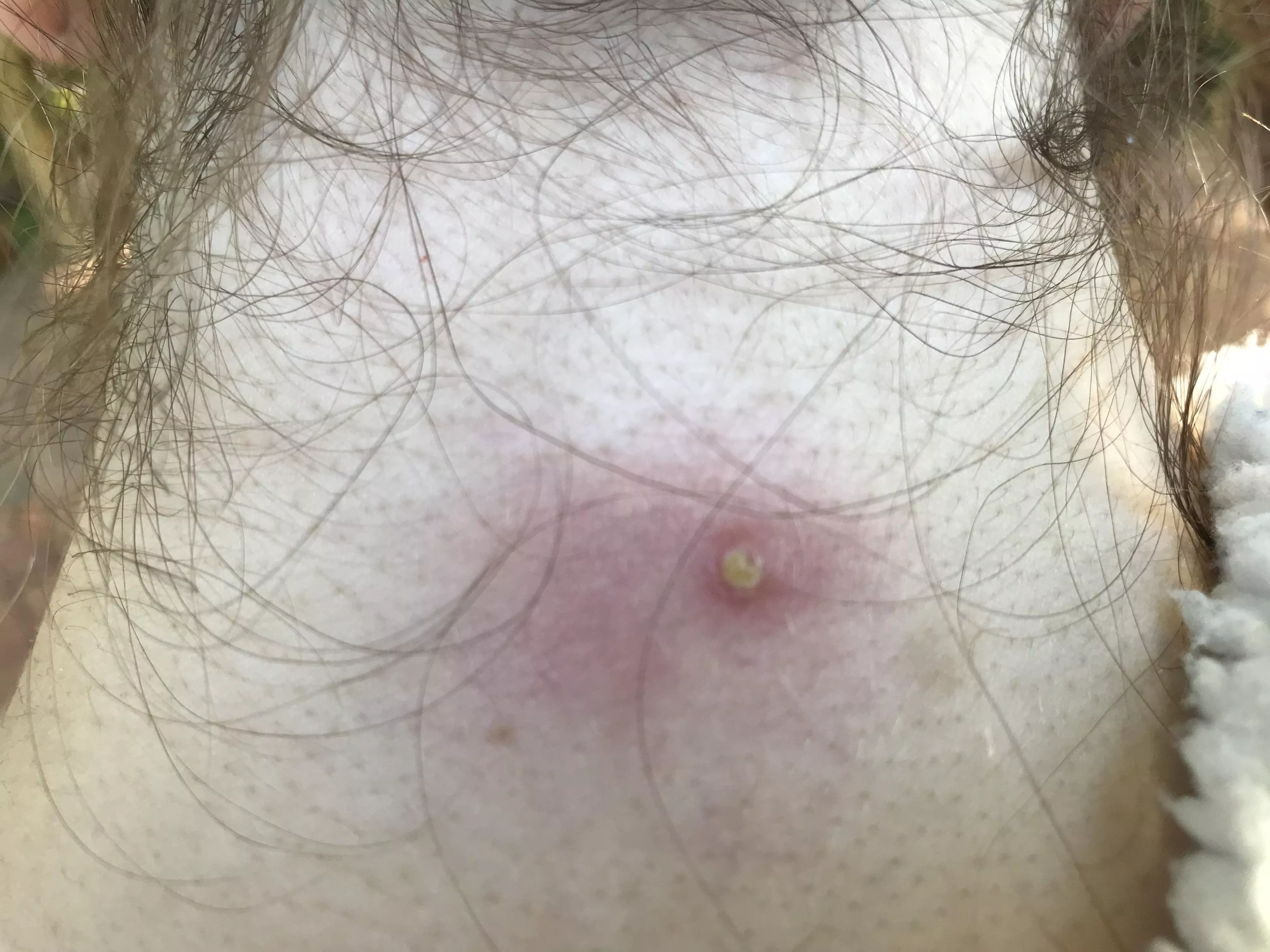 Got this cyst on the back of my neck that keeps growing and shrinking on its own and usually resolves itself but this time it is ANGRY. Must resist the urge to stab it posted by horseaholic2010