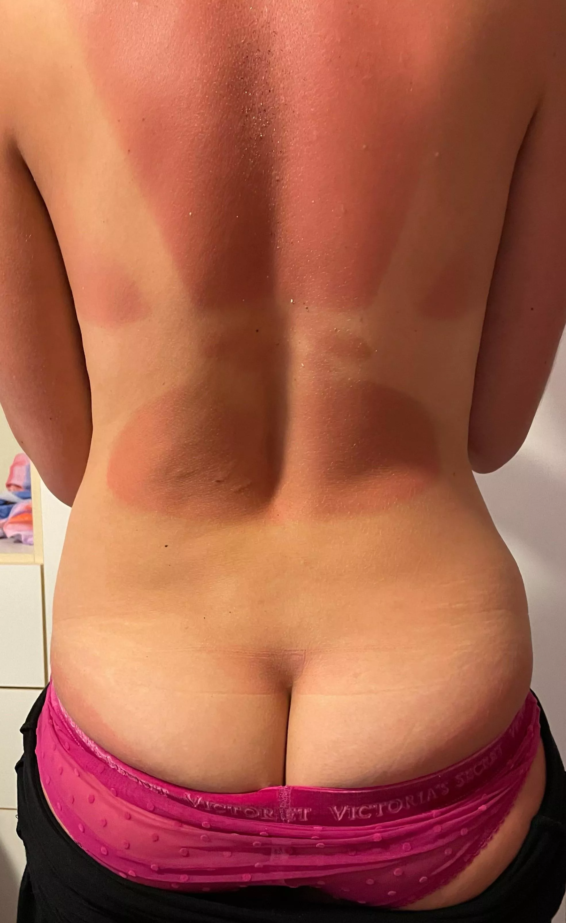 Guess I got carried away on vacation with no sunscreen posted by HeatherHopeful