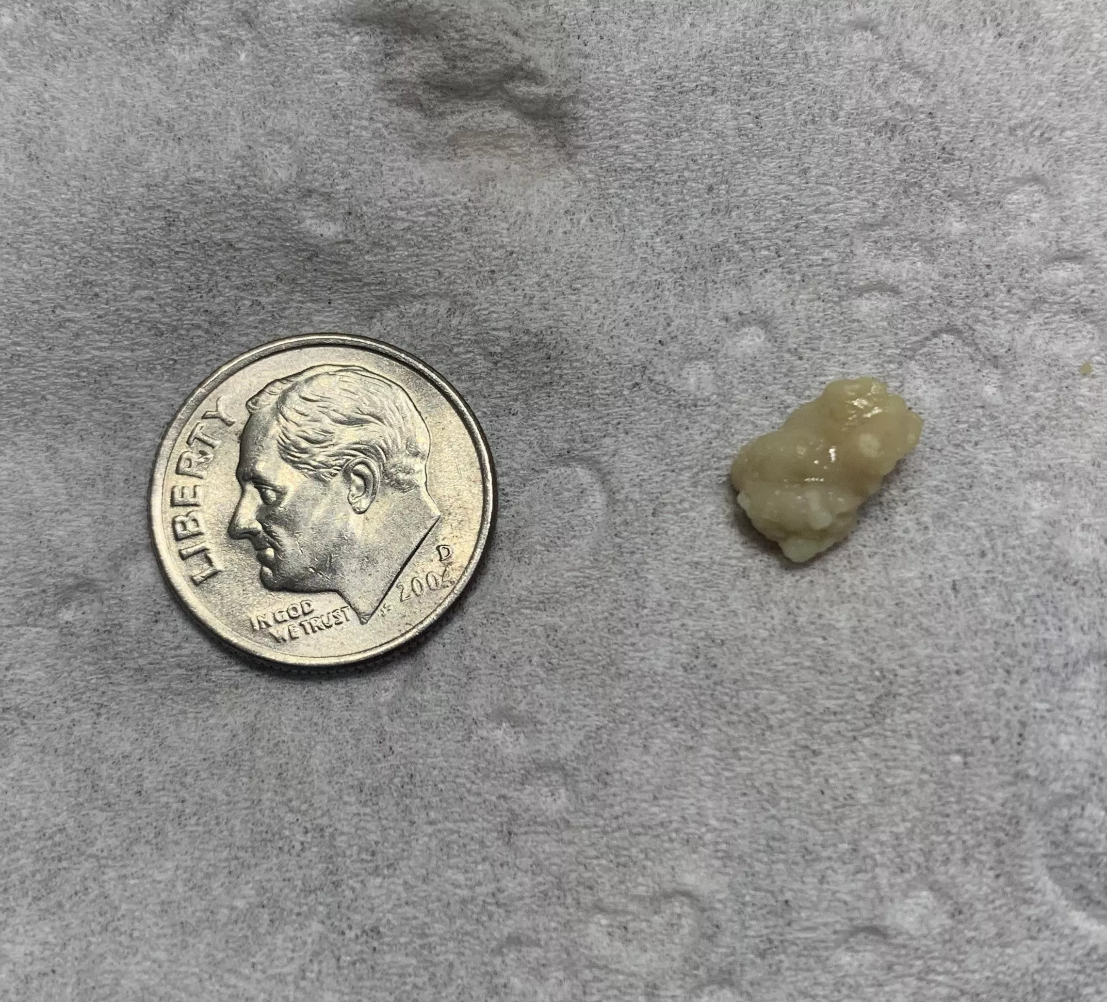 Huge tonsil stone I removed from my throat (from COVID-19) posted by rdwtoker