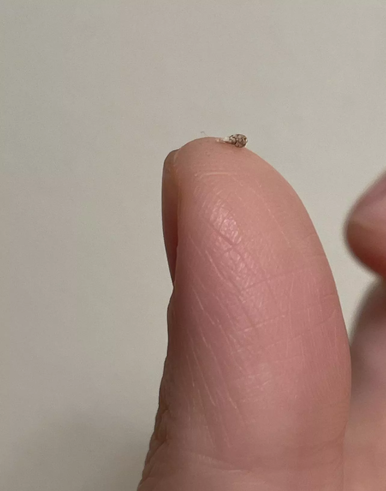 I accidentally scratched the pimple on my head (maybe an infected hair follicle, not sure) and when I squeezed it, this hard thing popped out. posted by mama_lu0831