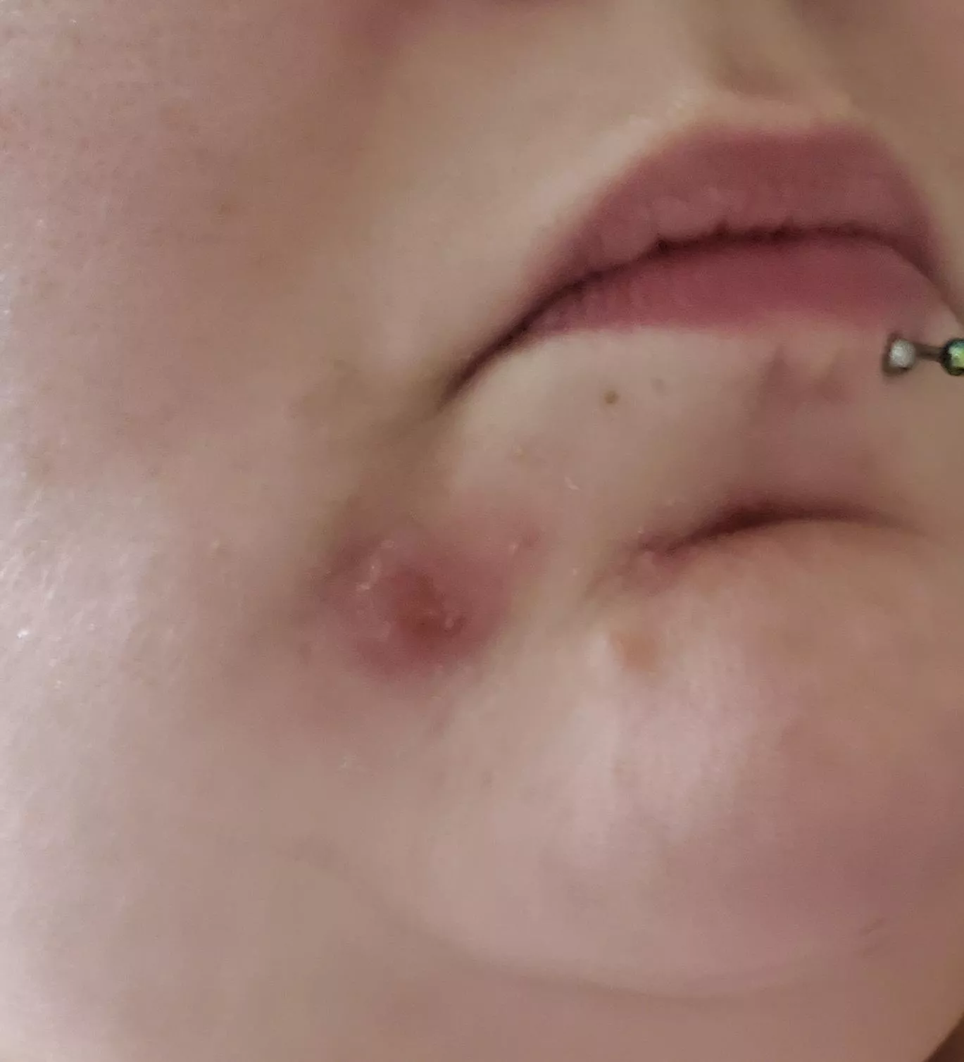 I get this every so often, and it stays for WEEKS if not months, it's sore and weeps often (that's why it looks crusty) doesn't come to a head, and eventually goes away on its own. I look gross because it's so huge posted by ChaosNCandy