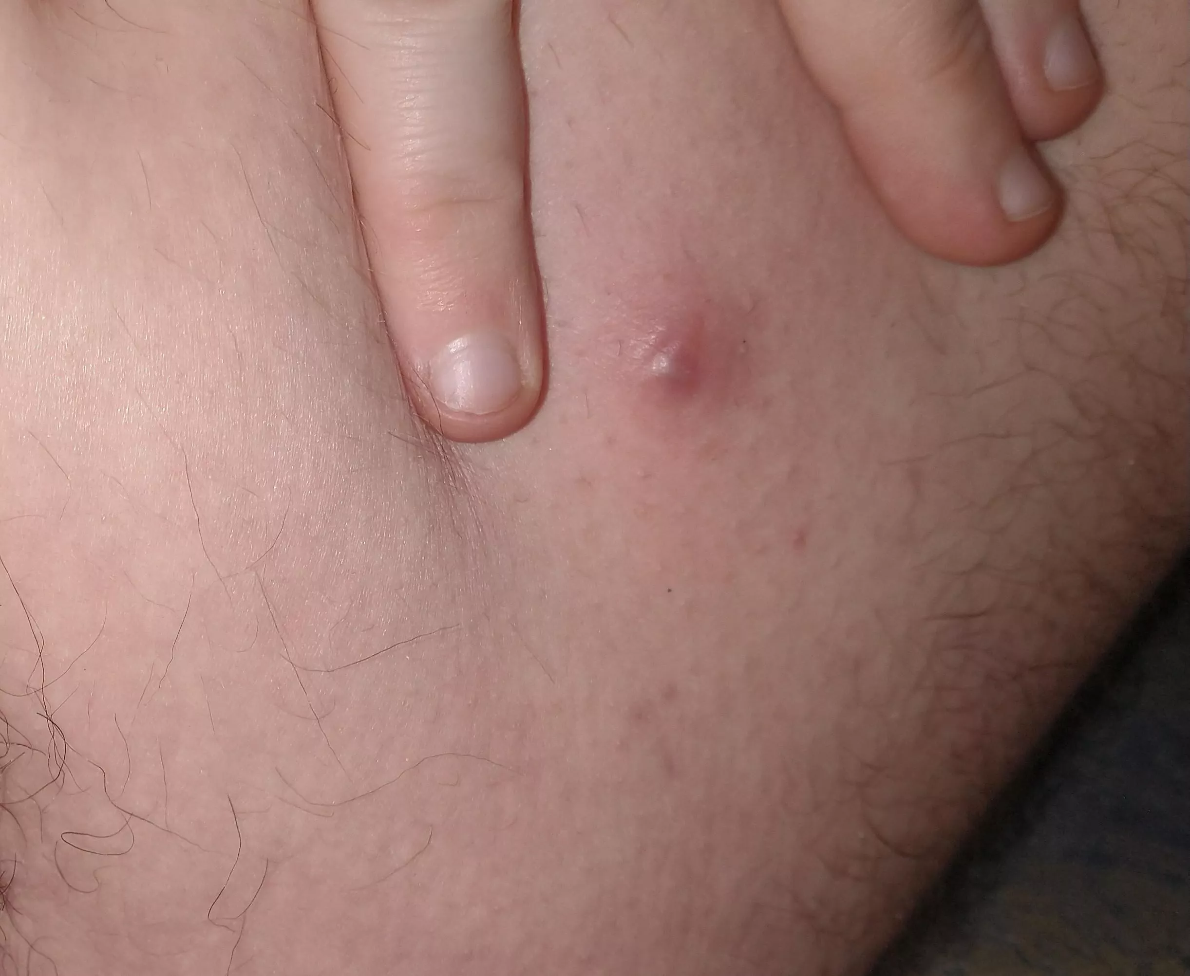 I just found a giant unpoppable zit on my inner thigh.. it's absolutely giant and mainly under the surface. very tempted to cut it open but am trying to stop myself posted by vinylveins