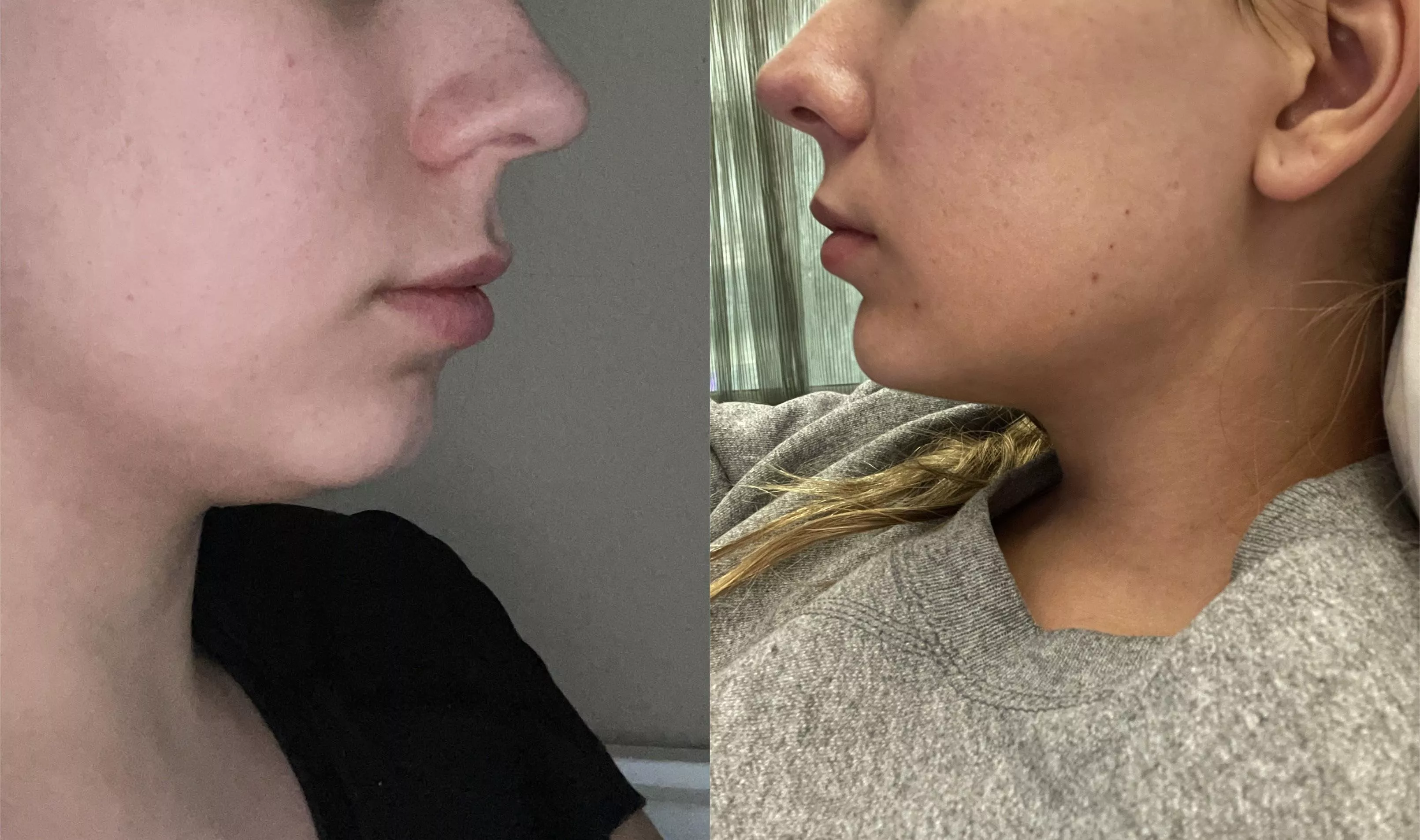 I know that people really love lip filler here, but I decided to show off my chin filler before/after too in case any bimbos are curious! posted by slutmeup