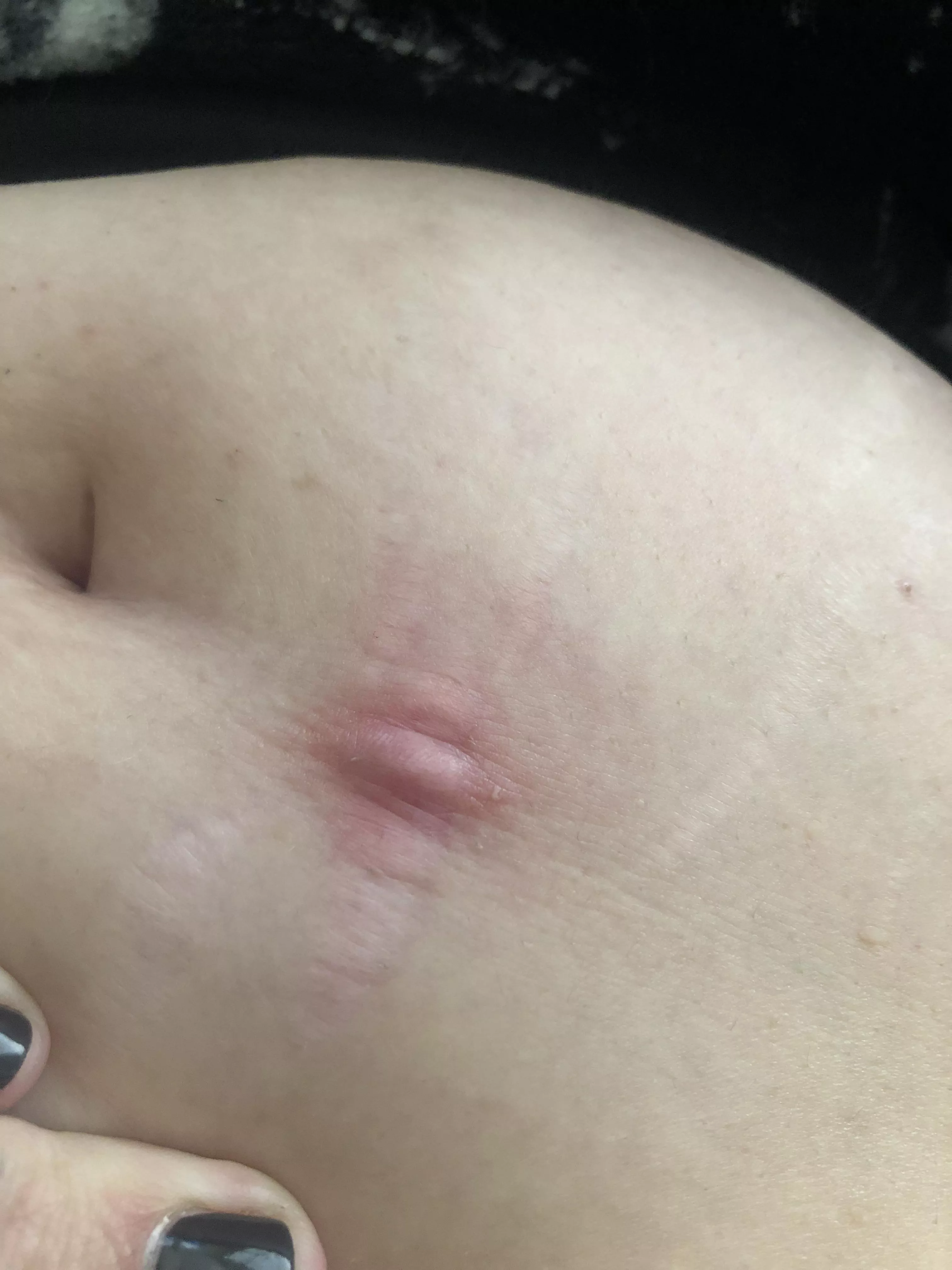 I know this was a perfect storm, but if you have a blackhead on a stretch mark in a belly fold, probably don’t poke around and pop it with not the cleanest hands. This doesn’t feel good! posted by metalmamalove