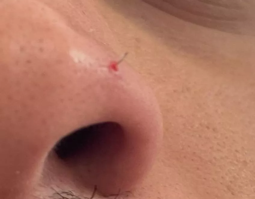 I popped a pimple on my nose and it turned out to be an ingrown hair. posted by ilovetacorice